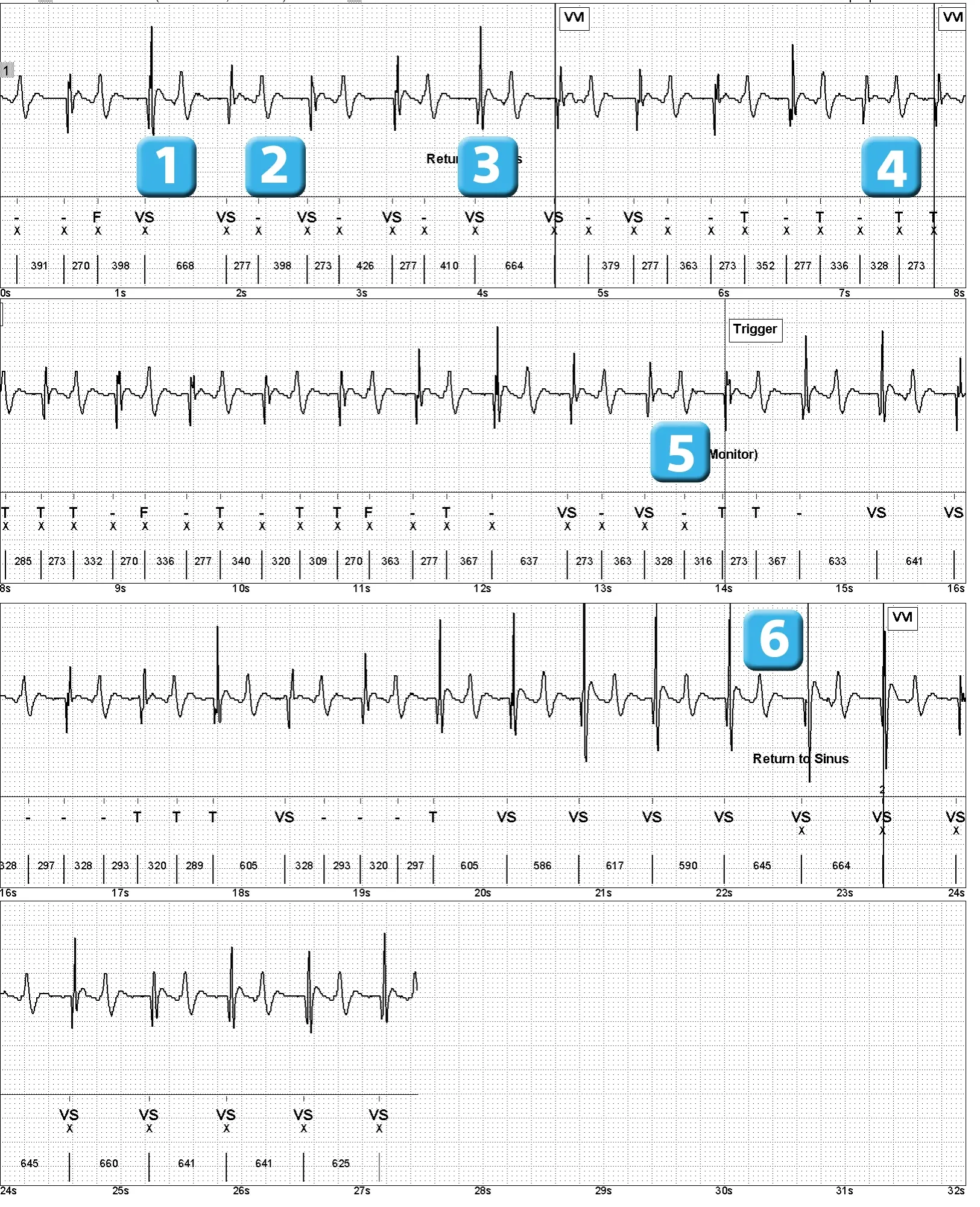 Électrogramme Abbott ICD, segment 1 sur 1 — Surdétection de l’onde T sur un modèle ancien