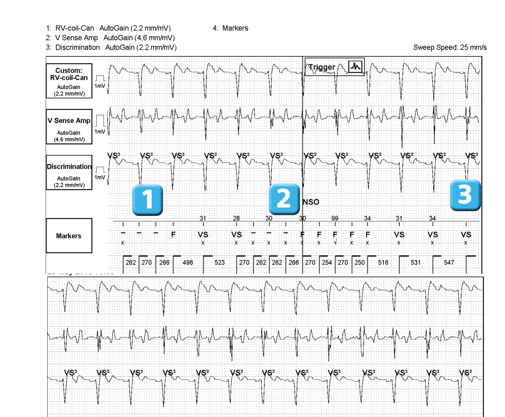 Électrogramme Abbott ICD, segment 1 sur 1 — Dispositif récent, surdétection de l’onde T et algorithme SecureSense™