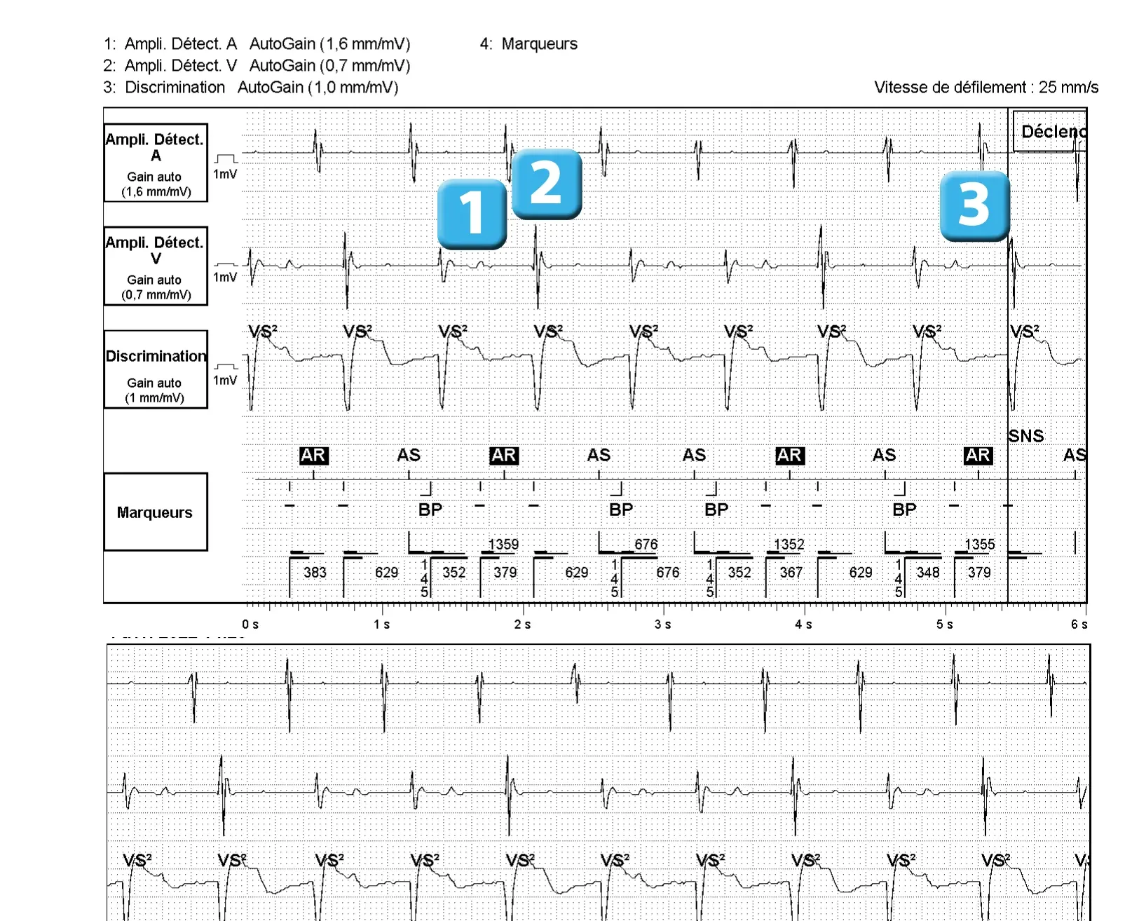 Électrogramme Abbott ICD, segment 1 sur 1 — Dispositif récent, surdétection de l’onde T post-stimulation et algorithme SecureSense™