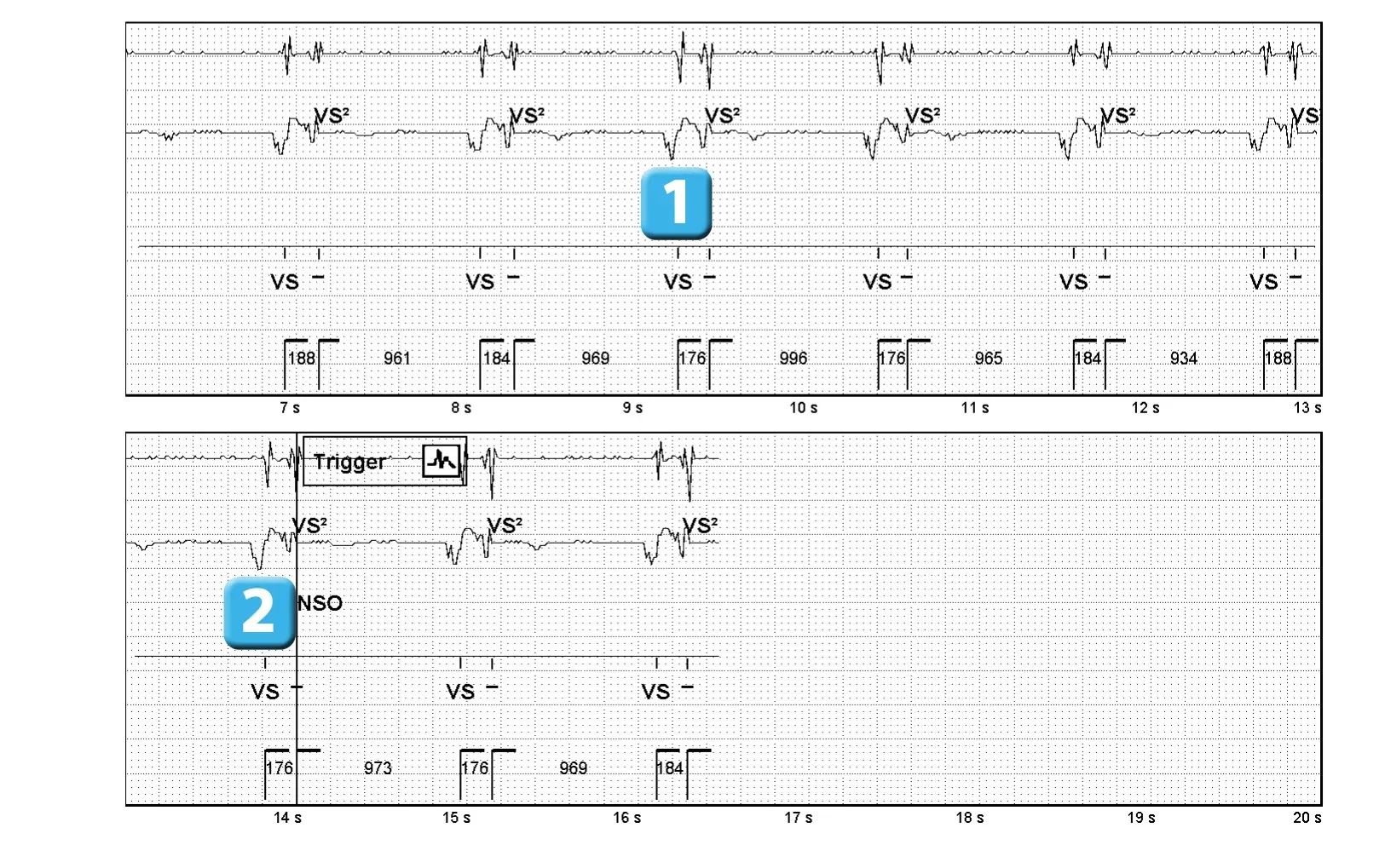 Électrogramme Abbott ICD, segment 1 sur 1 — Dispositif récent, surdétection de l’onde P et algorithme SecureSense™