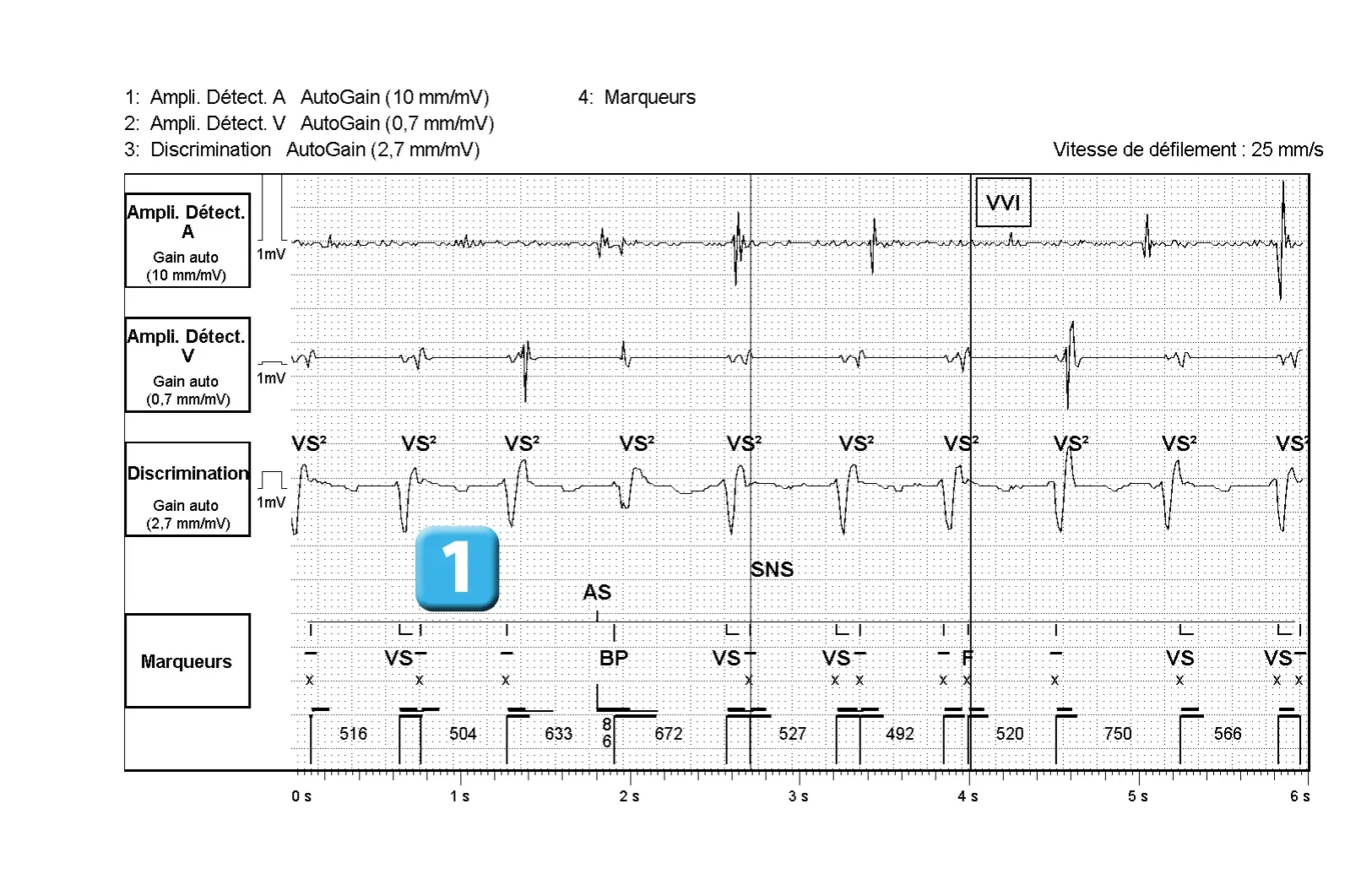 Électrogramme Abbott ICD, segment 1 sur 2 — Dispositif récent, double comptage de l’onde R et algorithme SecureSense™