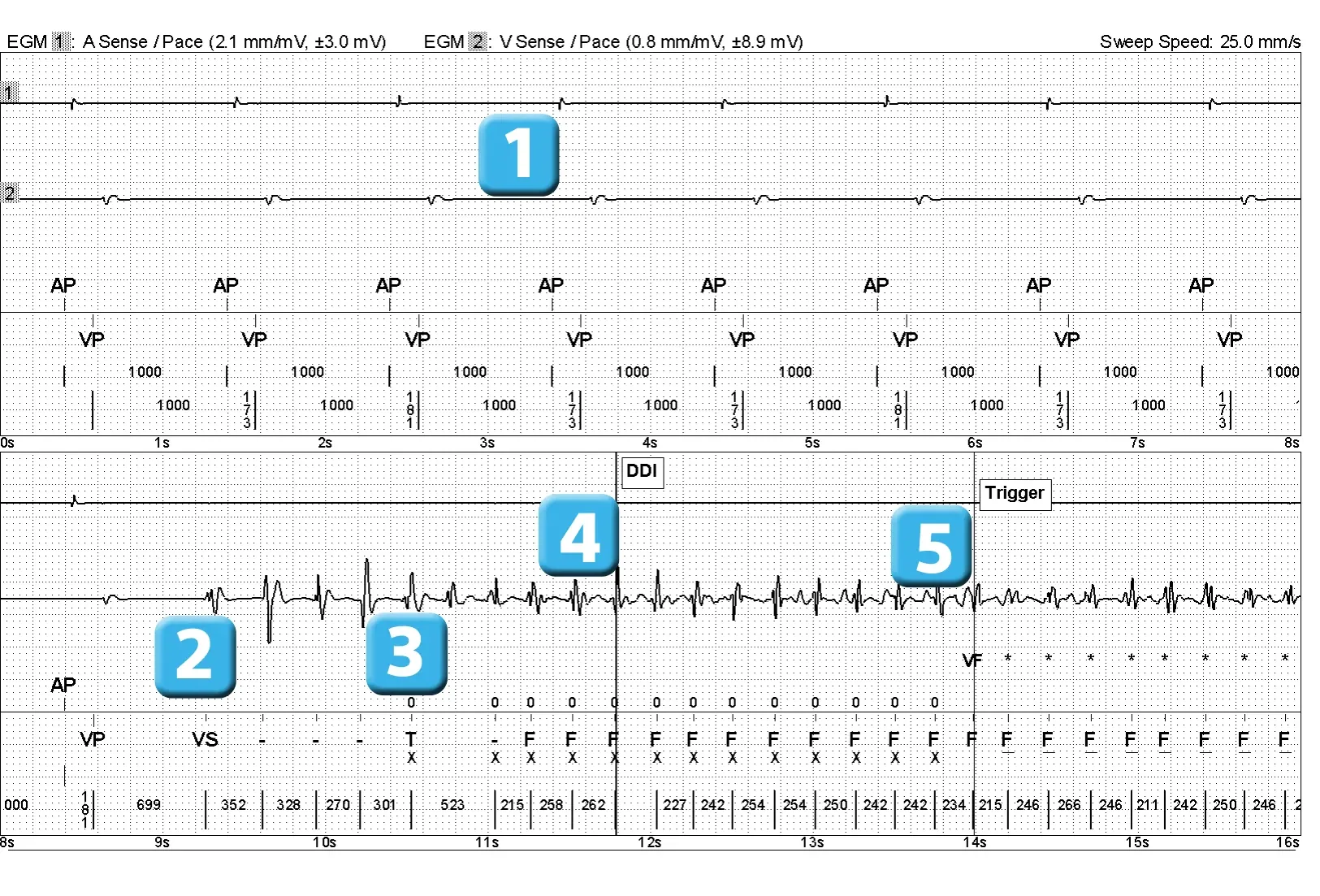 Électrogramme Abbott ICD, segment 1 sur 4 — Episode de fibrillation ventriculaire et seuil de défibrillation élevé
