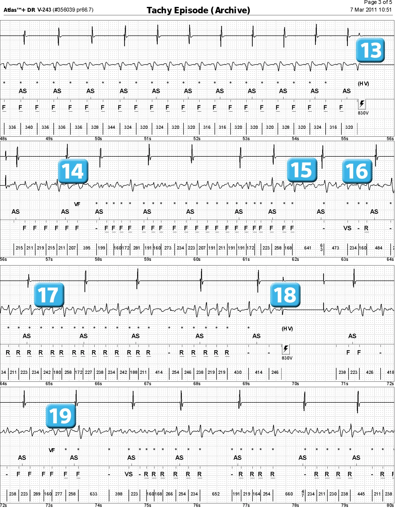 Électrogramme Abbott ICD, segment 3 sur 4 — Episode de fibrillation ventriculaire et seuil de défibrillation élevé