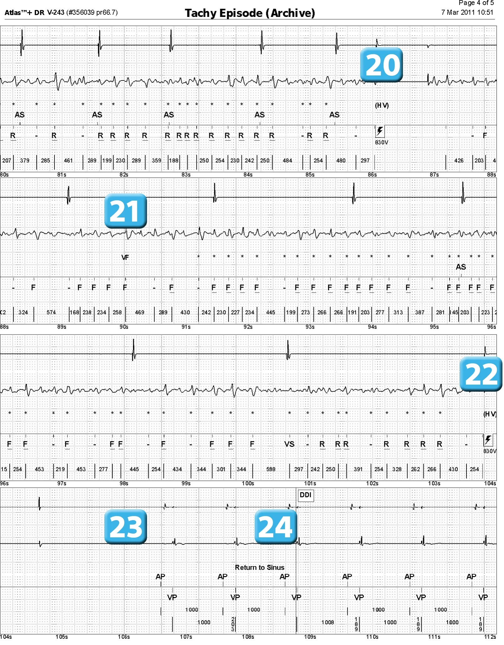 Électrogramme Abbott ICD, segment 4 sur 4 — Episode de fibrillation ventriculaire et seuil de défibrillation élevé