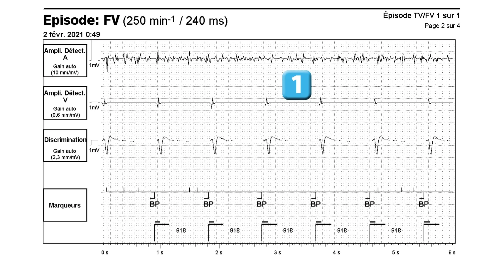 Électrogramme Abbott ICD, segment 1 sur 4 — Dysfonction de sonde et algorithme DynamicTx™