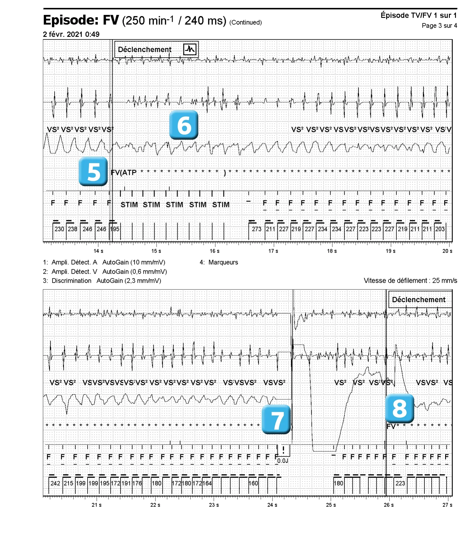 Électrogramme Abbott ICD, segment 3 sur 4 — Dysfonction de sonde et algorithme DynamicTx™