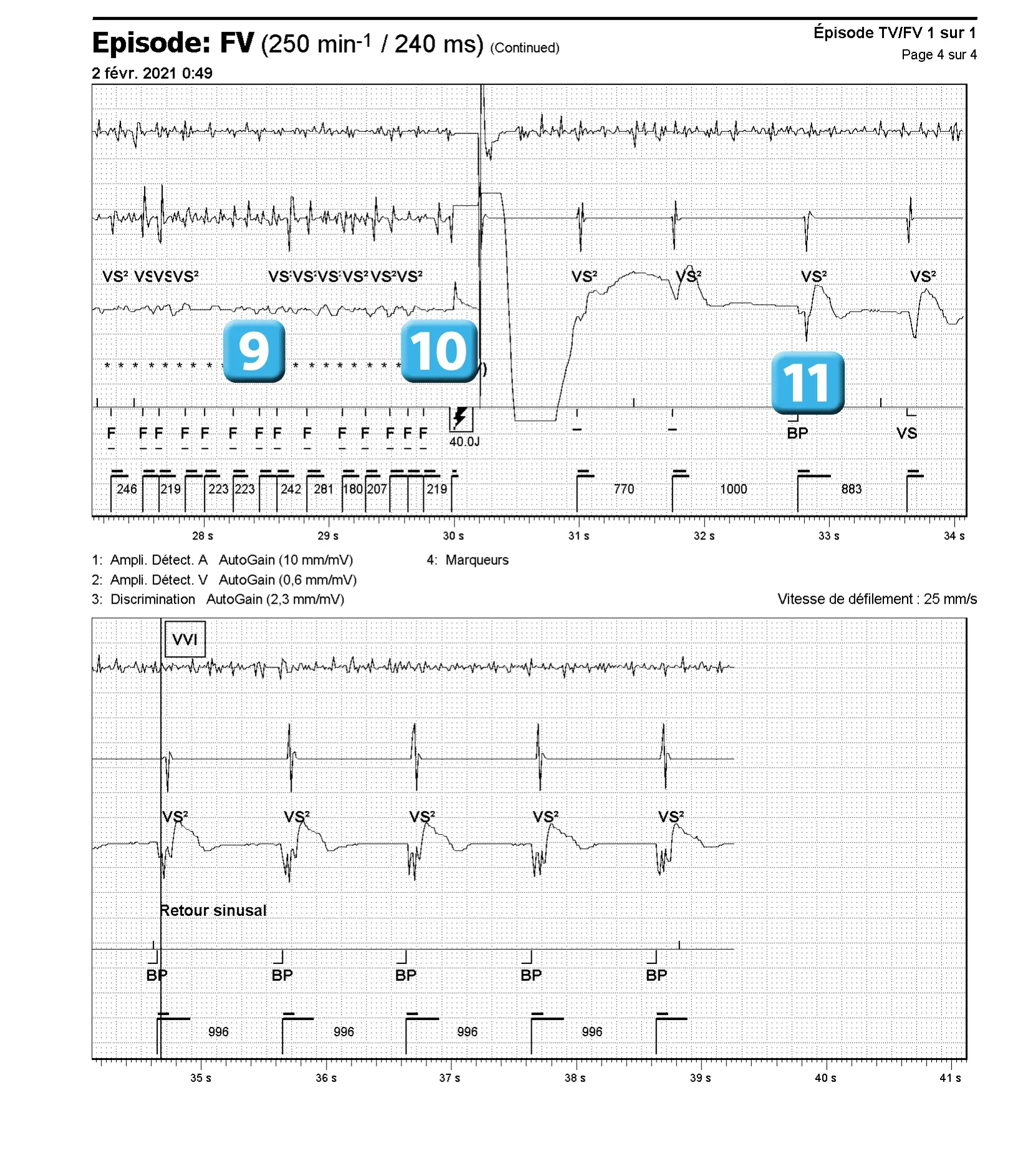 Électrogramme Abbott ICD, segment 4 sur 4 — Dysfonction de sonde et algorithme DynamicTx™