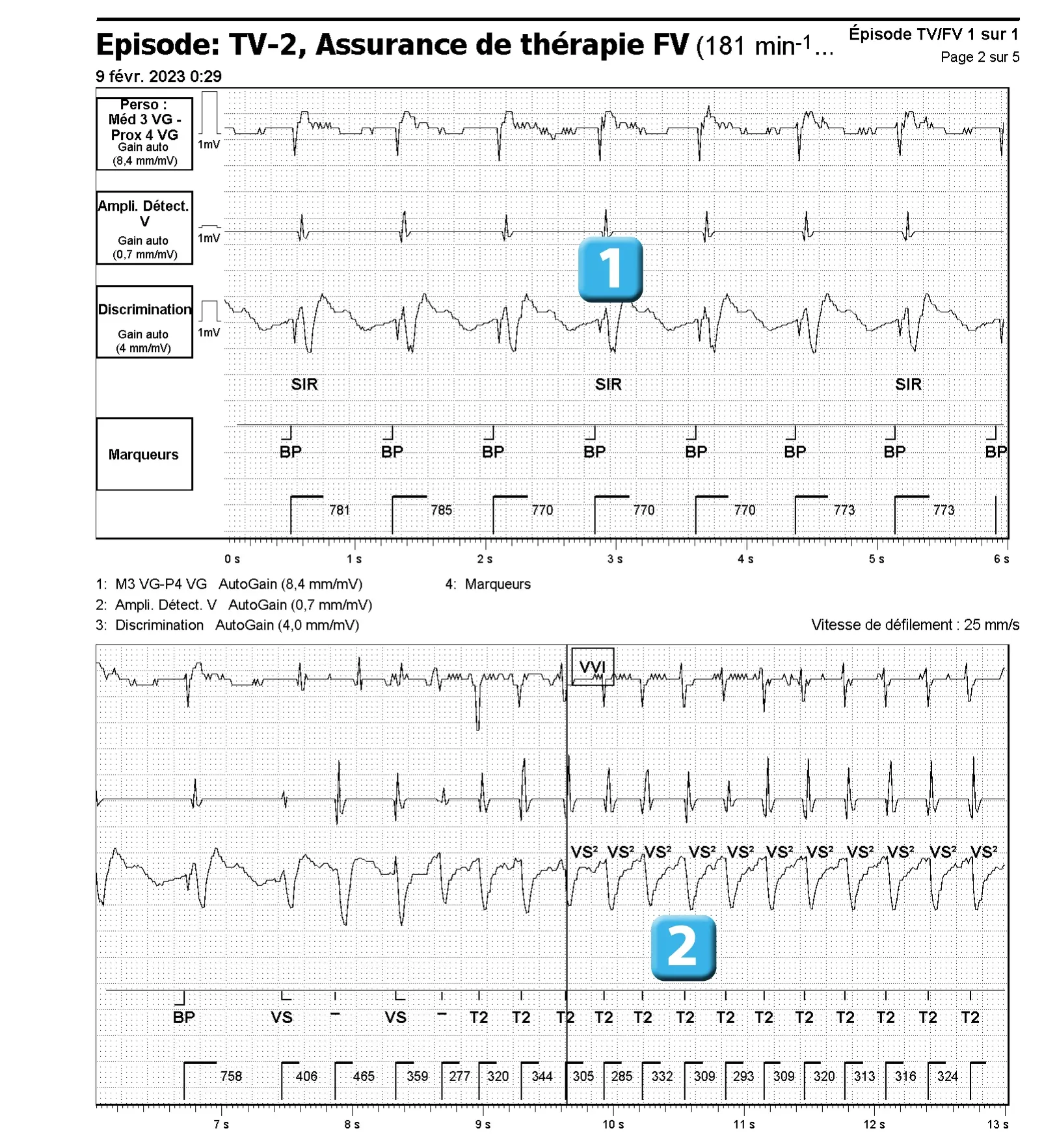 Électrogramme Abbott ICD, segment 1 sur 4 — Activation de l’algorithme VFTA pour favoriser la délivrance d’un choc électrique lors d’un épisode d’arythmie ventriculaire