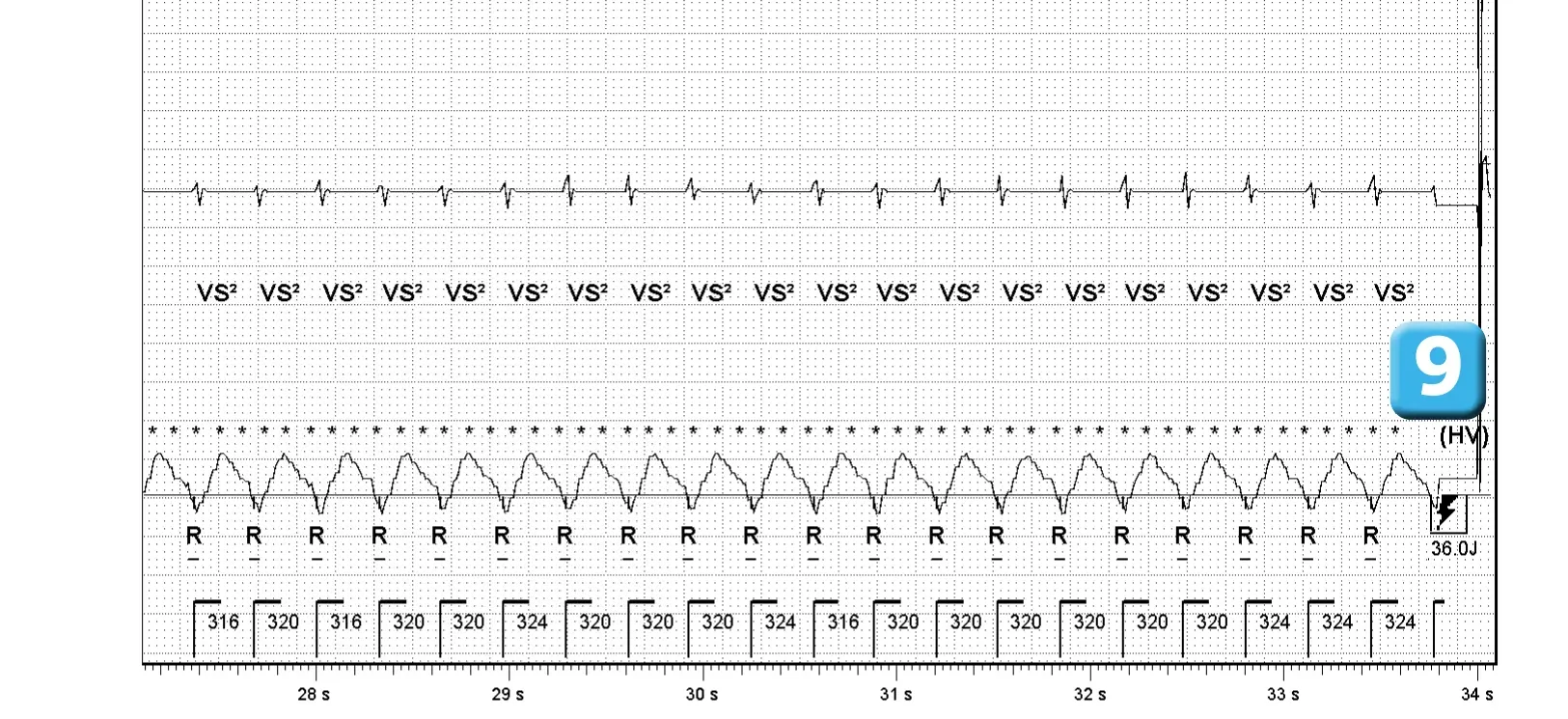 Électrogramme Abbott ICD, segment 3 sur 4 — Activation de l’algorithme VFTA pour favoriser la délivrance d’un choc électrique lors d’un épisode d’arythmie ventriculaire