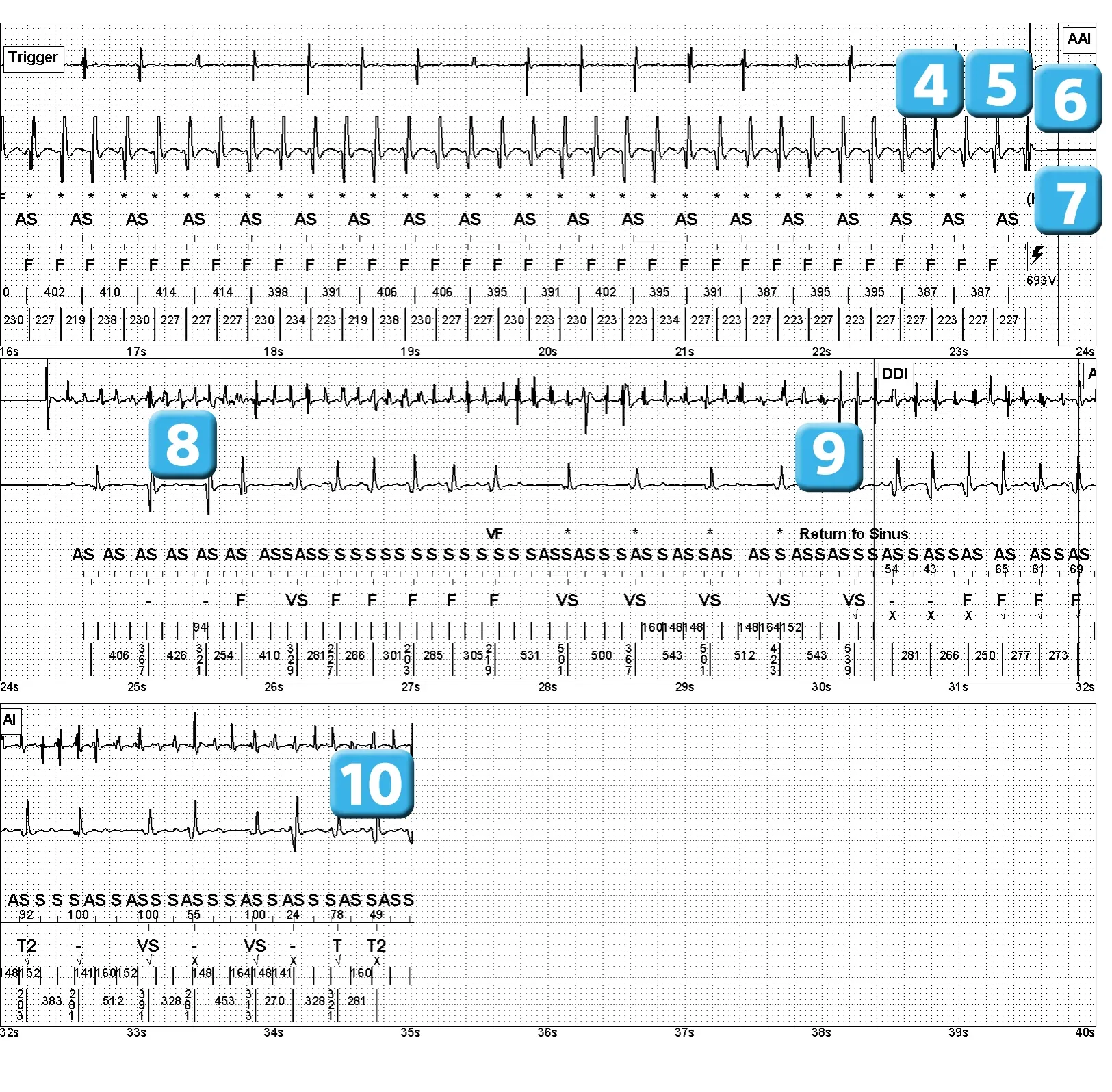 Électrogramme Abbott ICD, segment 3 sur 3 — Choc électrique et induction d’un épisode de FA