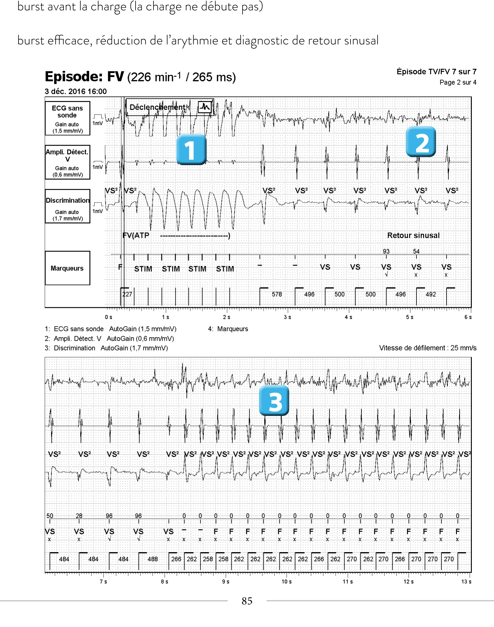 Stimulation anti-tachycardique pendant ou avant la charge en zone de FV