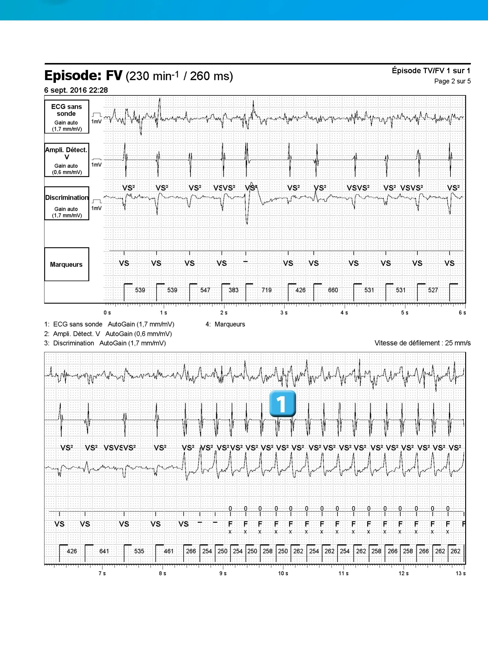 Stimulation anti-tachycardique pendant ou avant la charge en zone de FV