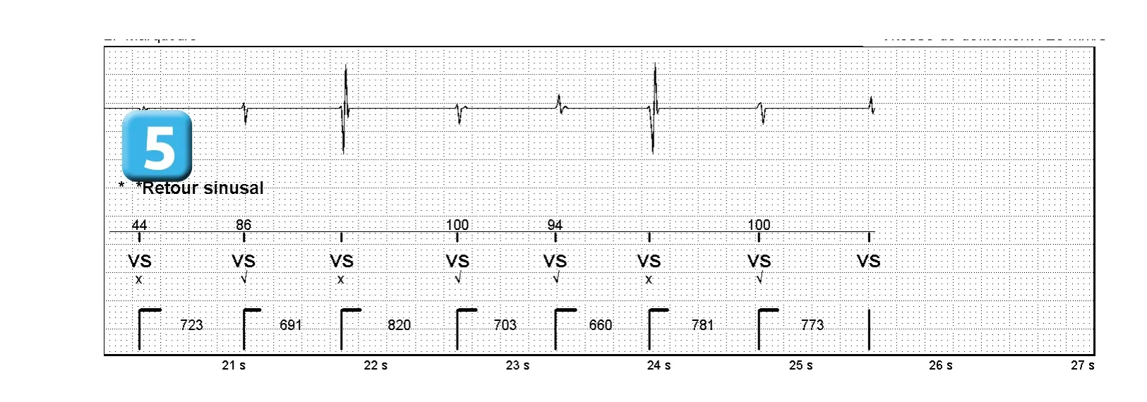 Électrogramme Abbott ICD, segment 2 sur 2 — Stimulation anti-tachycardique pendant ou avant la charge en zone de FV