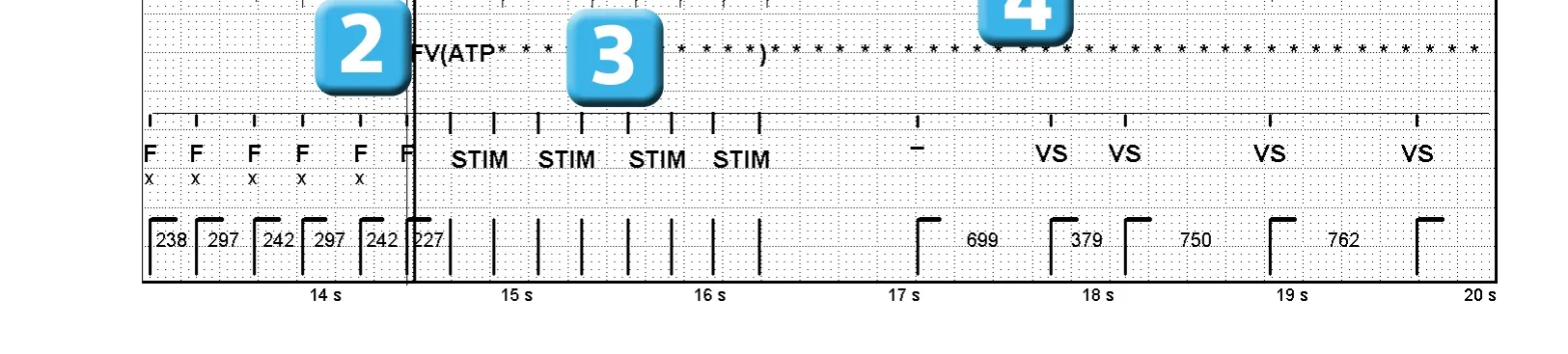 Électrogramme Abbott ICD, segment 1 sur 1 — Stimulation anti-tachycardique pendant ou avant la charge en zone de FV