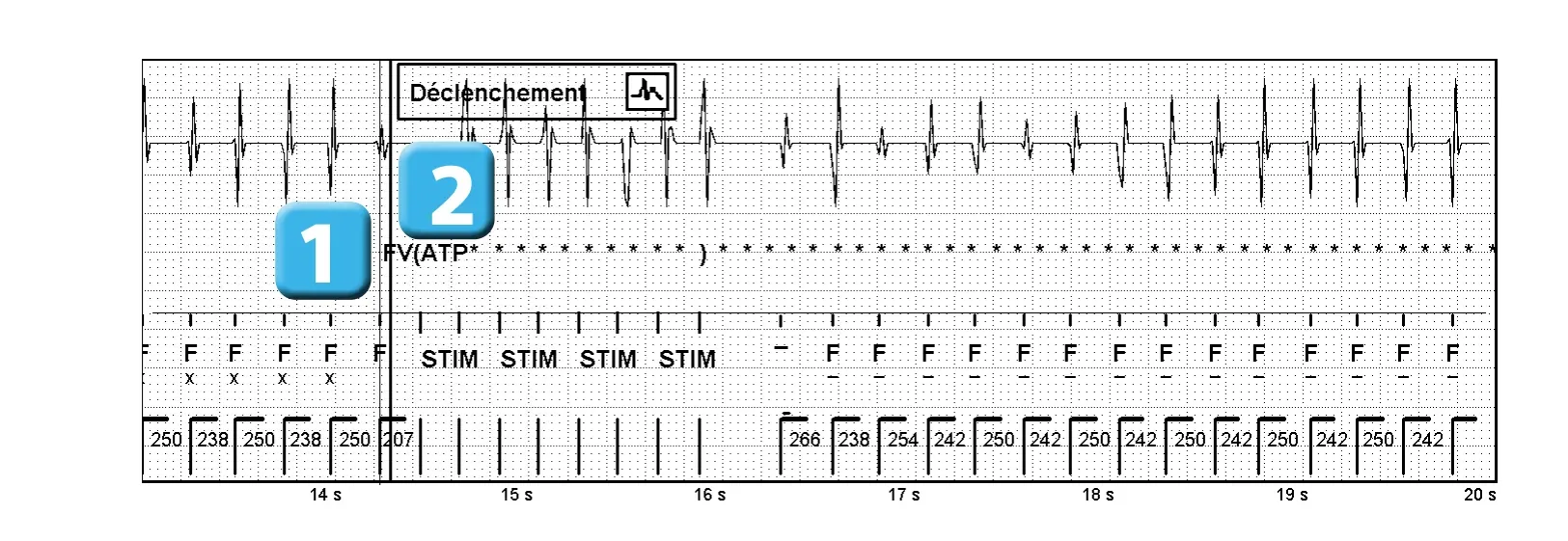 Électrogramme Abbott ICD, segment 1 sur 1 — Stimulation anti-tachycardique pendant ou avant la charge en zone de FV