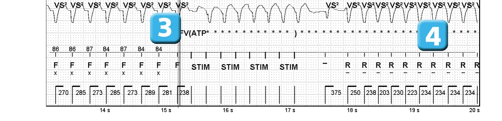 Électrogramme Abbott ICD, segment 1 sur 3 — ATP pendant la charge et accélération de la tachycardie