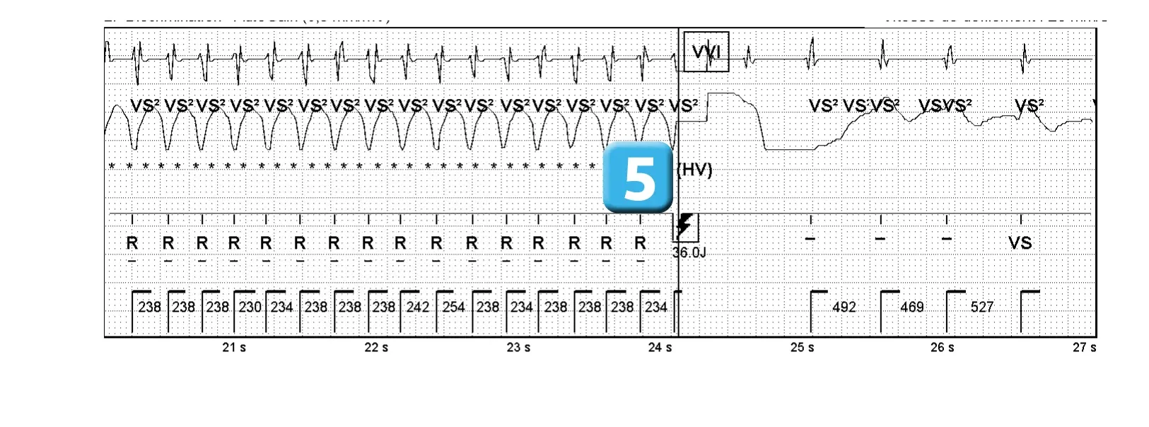 Électrogramme Abbott ICD, segment 2 sur 3 — ATP pendant la charge et accélération de la tachycardie