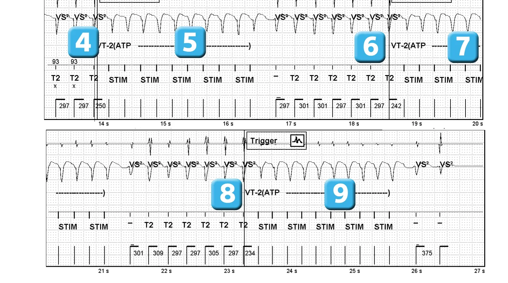 Électrogramme Abbott ICD, segment 1 sur 2 — Séquence de thérapies en zone de TV