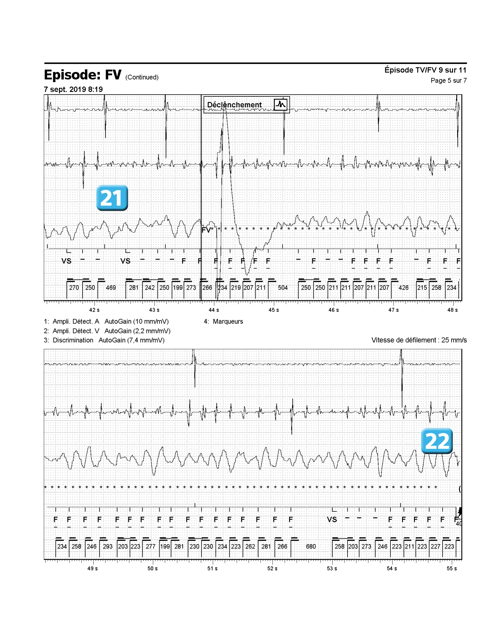 Accélération d’une TV par une stimulation anti-tachycardique et seuil de défibrillation élevé