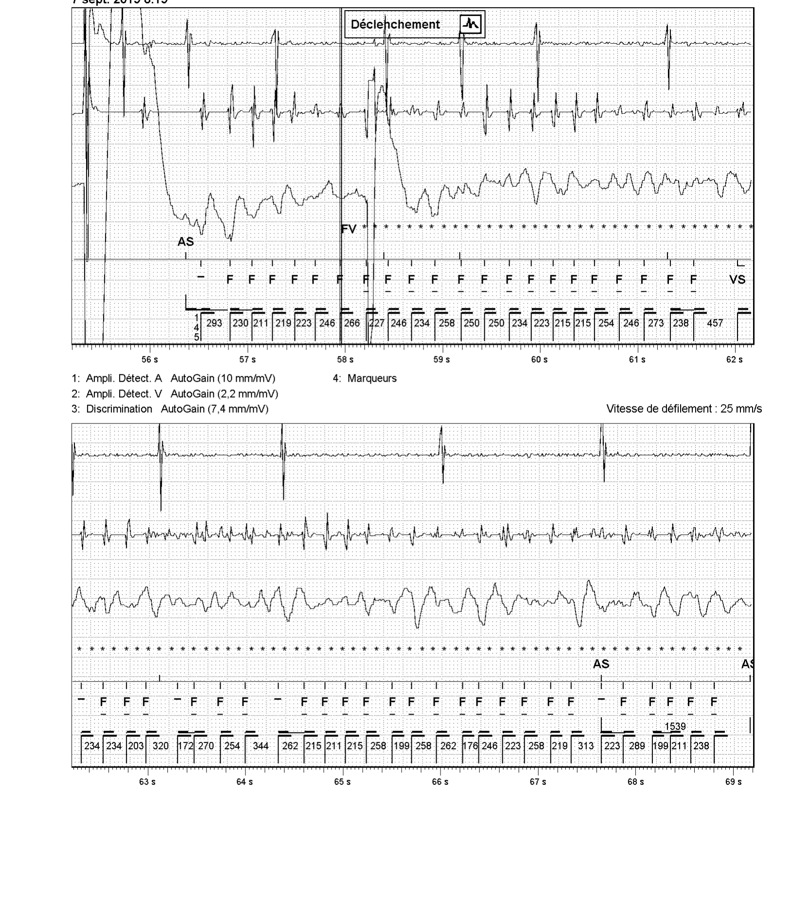 Accélération d’une TV par une stimulation anti-tachycardique et seuil de défibrillation élevé