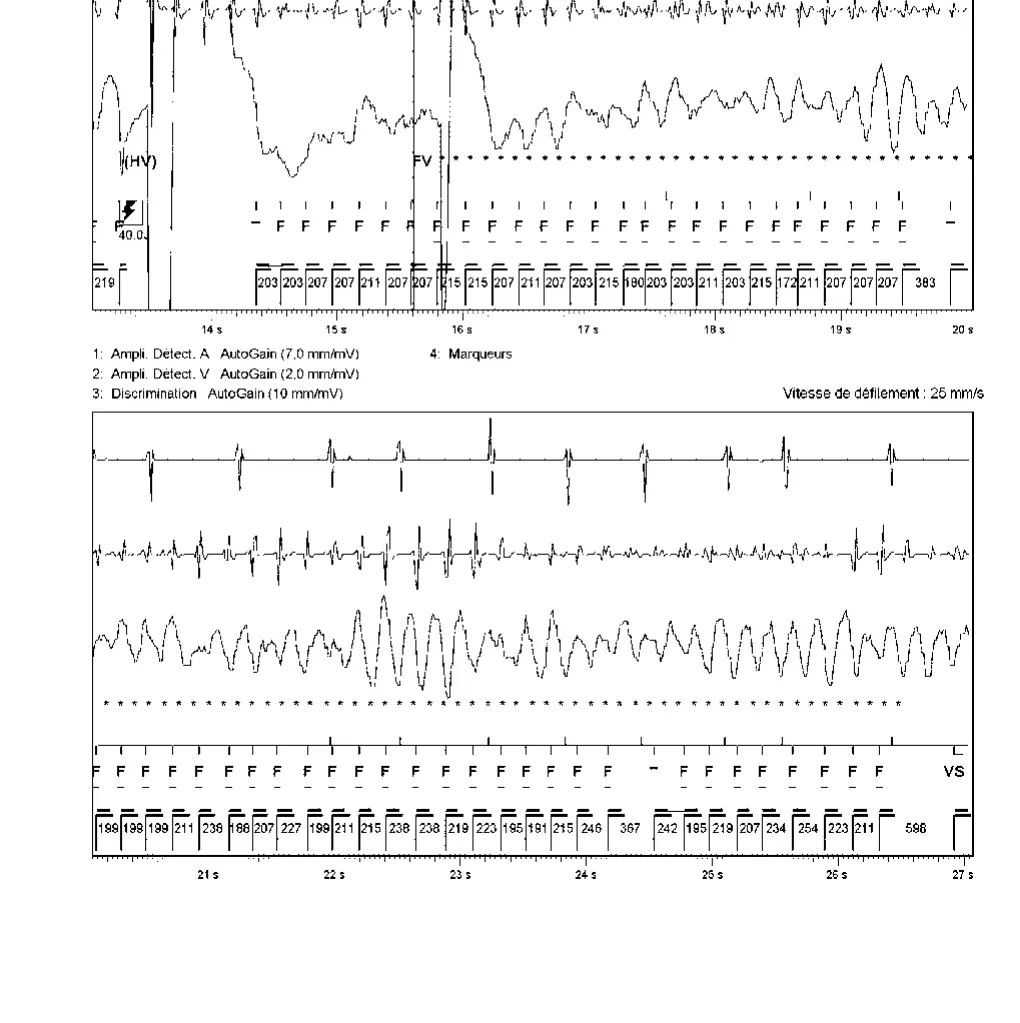 Accélération d’une TV par une stimulation anti-tachycardique et seuil de défibrillation élevé