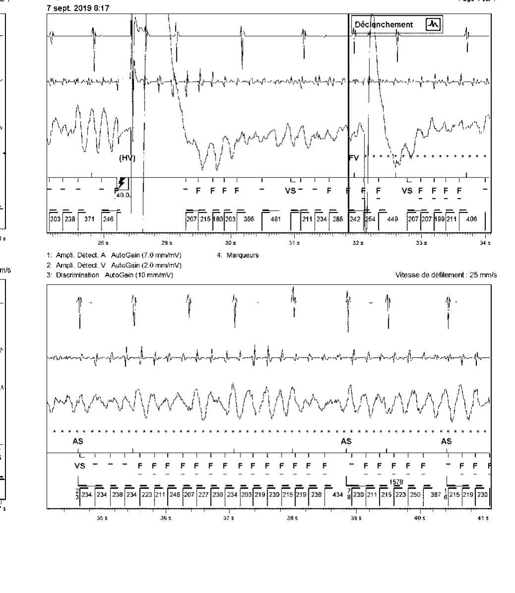 Accélération d’une TV par une stimulation anti-tachycardique et seuil de défibrillation élevé