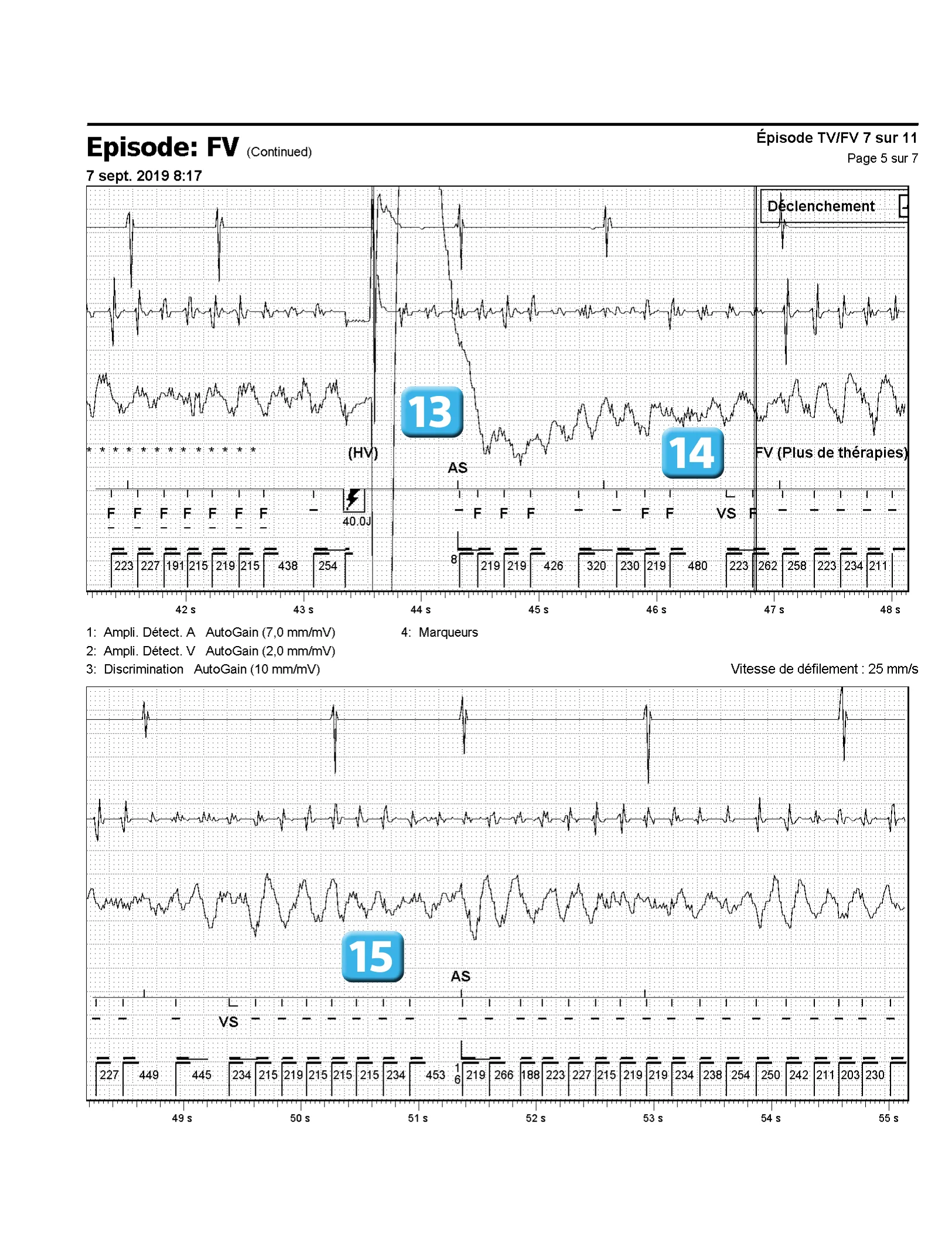 Accélération d’une TV par une stimulation anti-tachycardique et seuil de défibrillation élevé