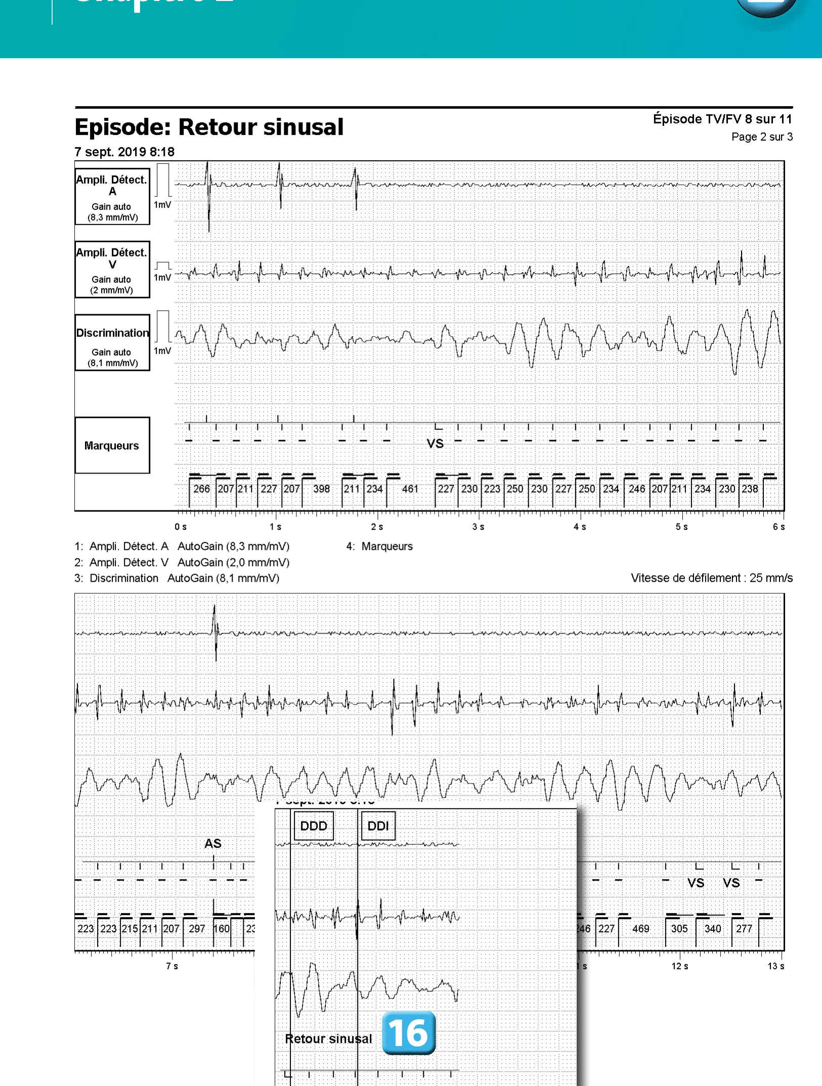 Accélération d’une TV par une stimulation anti-tachycardique et seuil de défibrillation élevé