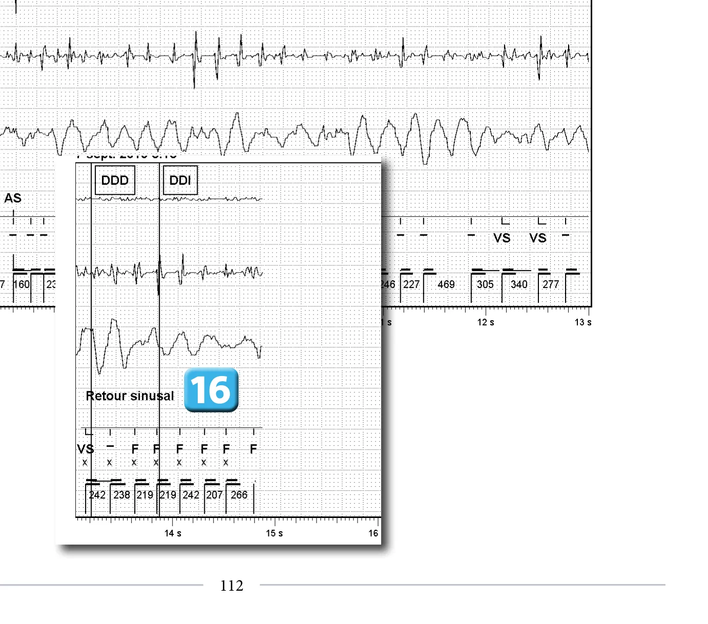 Accélération d’une TV par une stimulation anti-tachycardique et seuil de défibrillation élevé