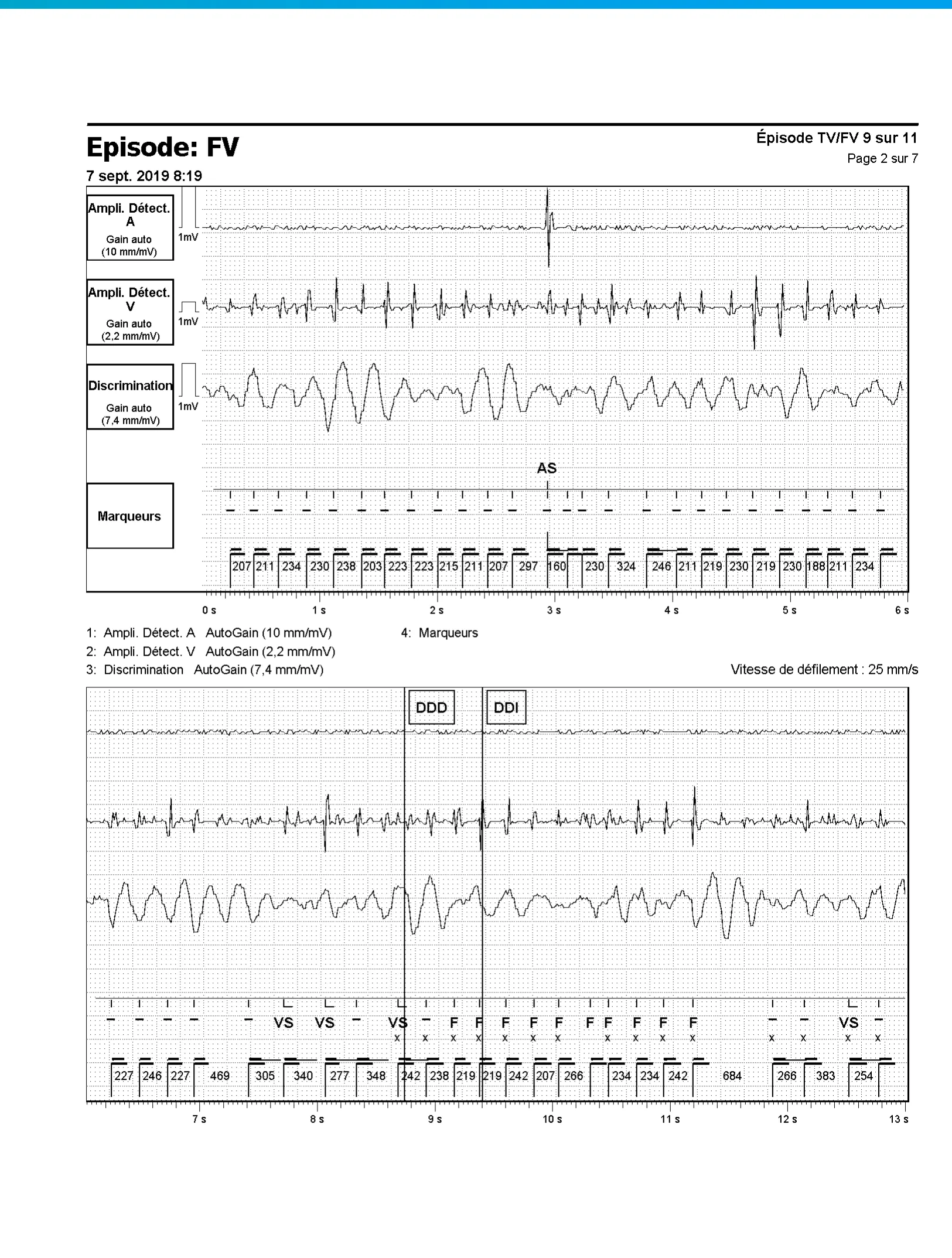 Accélération d’une TV par une stimulation anti-tachycardique et seuil de défibrillation élevé