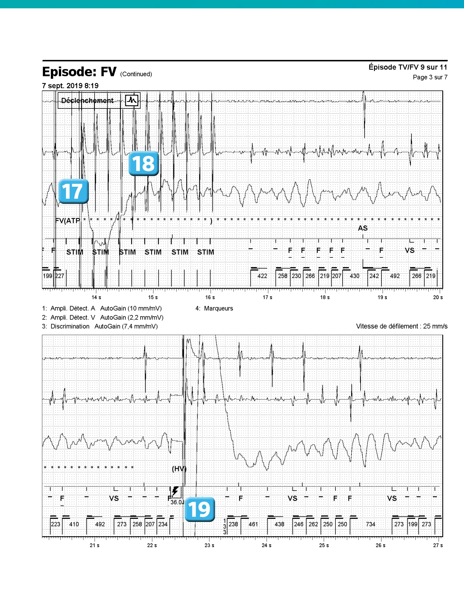 Accélération d’une TV par une stimulation anti-tachycardique et seuil de défibrillation élevé