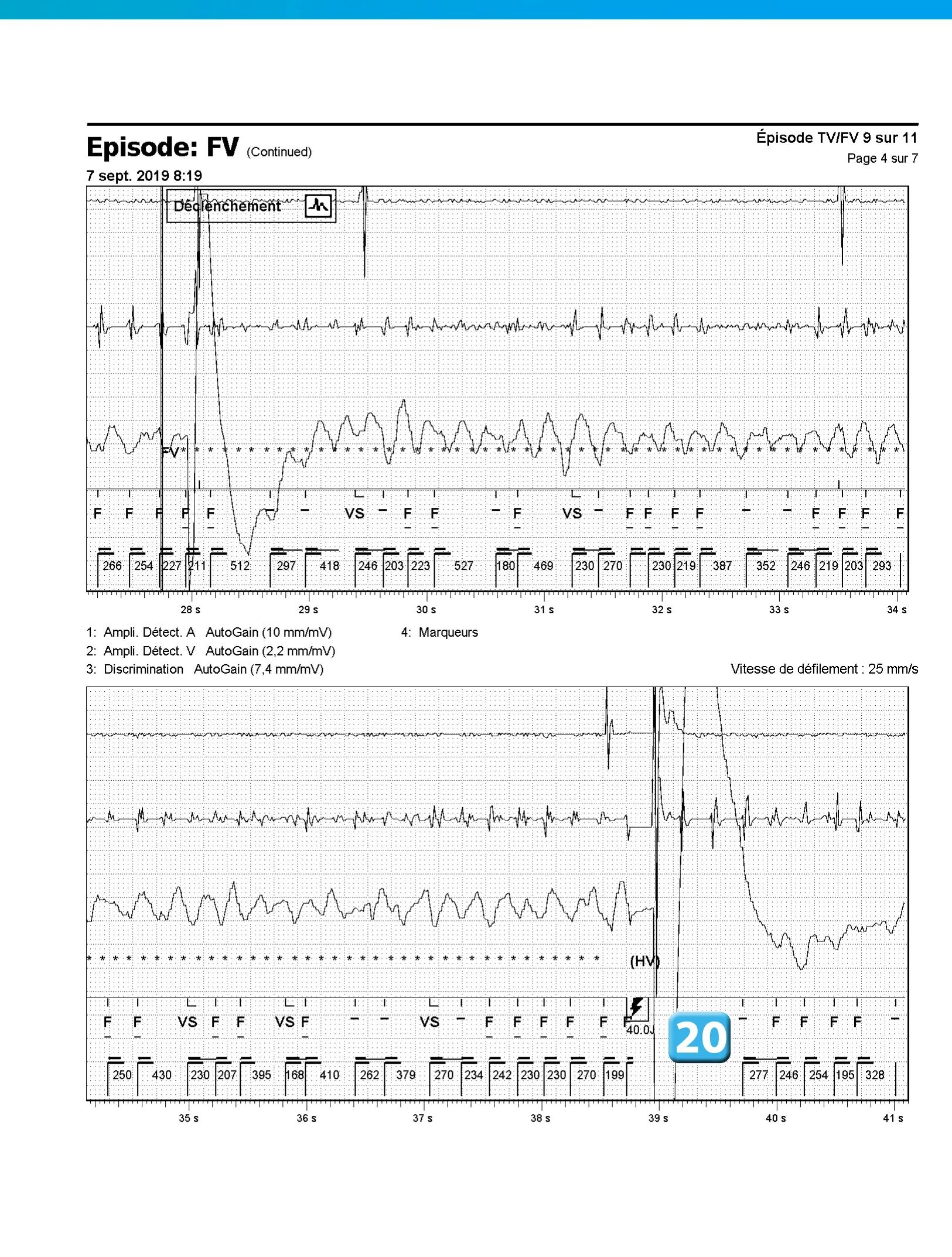Accélération d’une TV par une stimulation anti-tachycardique et seuil de défibrillation élevé