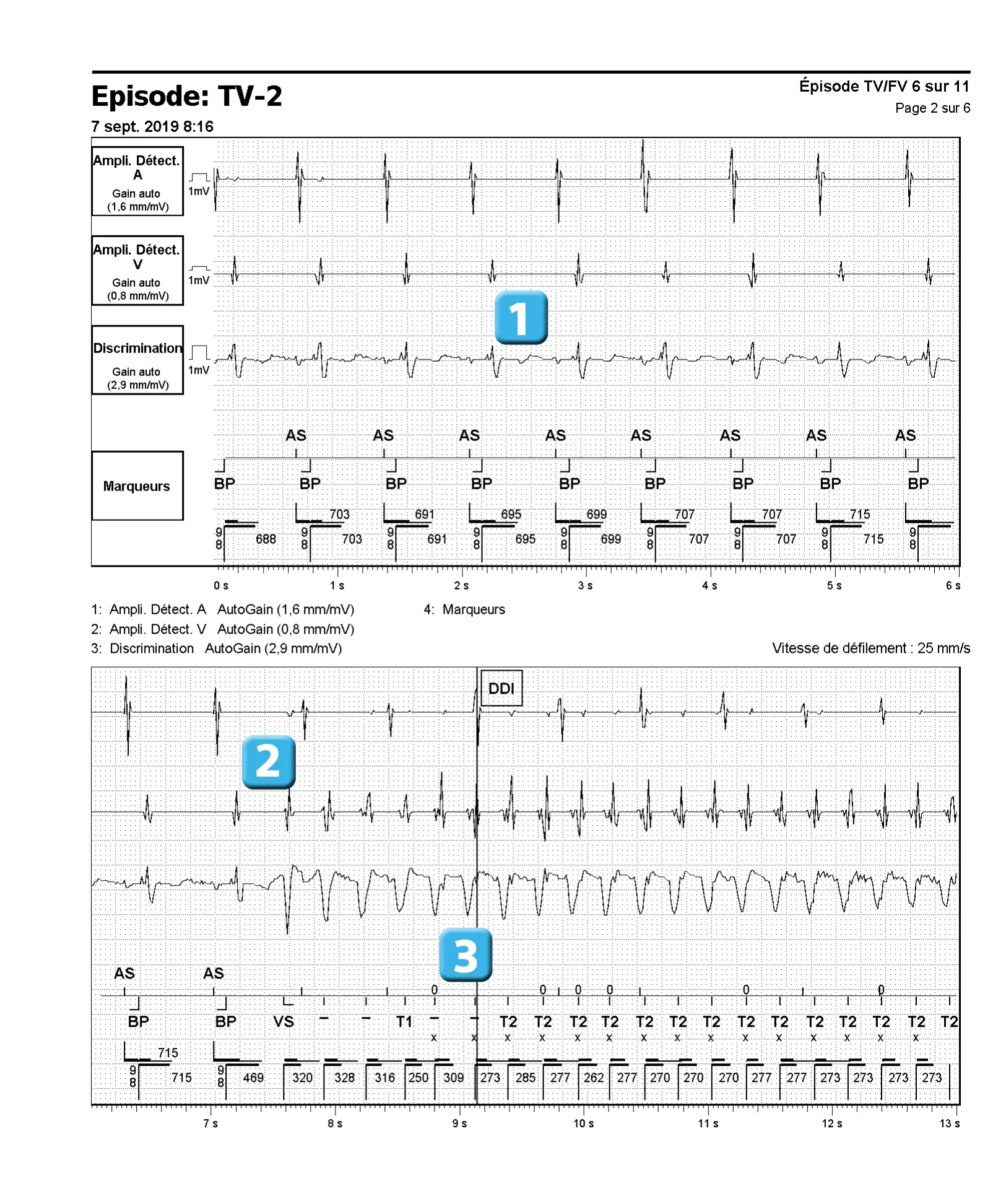 Électrogramme Abbott ICD, segment 1 sur 6 — Accélération d’une TV par une stimulation anti-tachycardique et seuil de défibrillation élevé