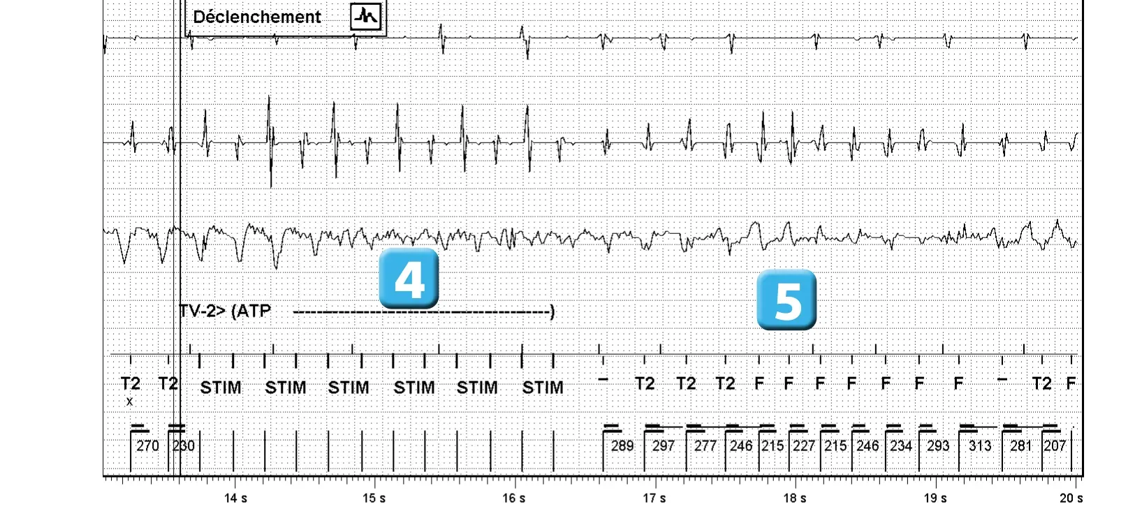 Électrogramme Abbott ICD, segment 2 sur 6 — Accélération d’une TV par une stimulation anti-tachycardique et seuil de défibrillation élevé