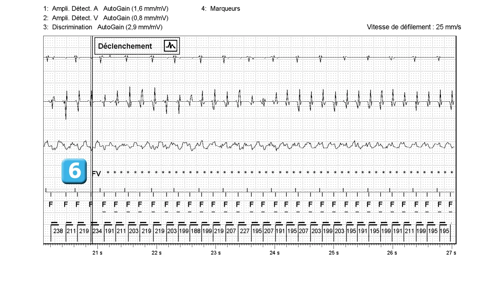 Électrogramme Abbott ICD, segment 3 sur 6 — Accélération d’une TV par une stimulation anti-tachycardique et seuil de défibrillation élevé