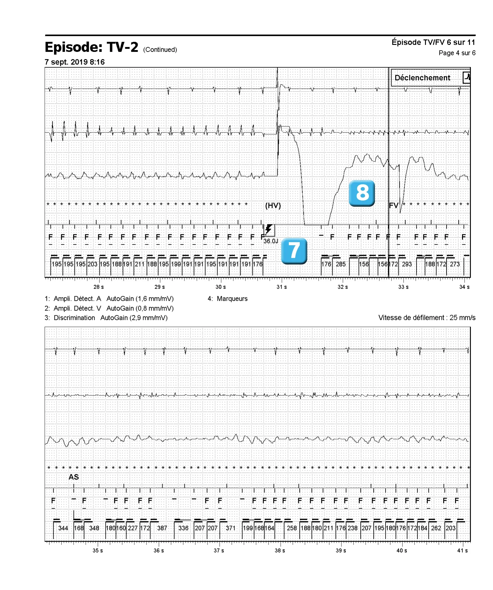 Électrogramme Abbott ICD, segment 4 sur 6 — Accélération d’une TV par une stimulation anti-tachycardique et seuil de défibrillation élevé