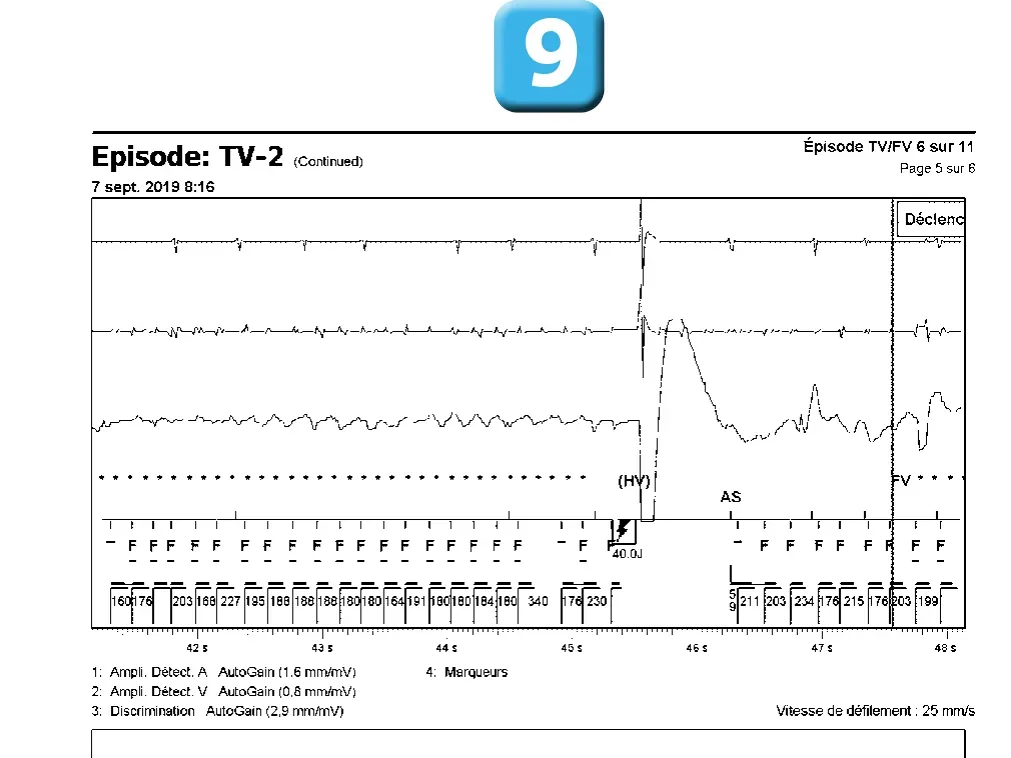 Électrogramme Abbott ICD, segment 5 sur 6 — Accélération d’une TV par une stimulation anti-tachycardique et seuil de défibrillation élevé