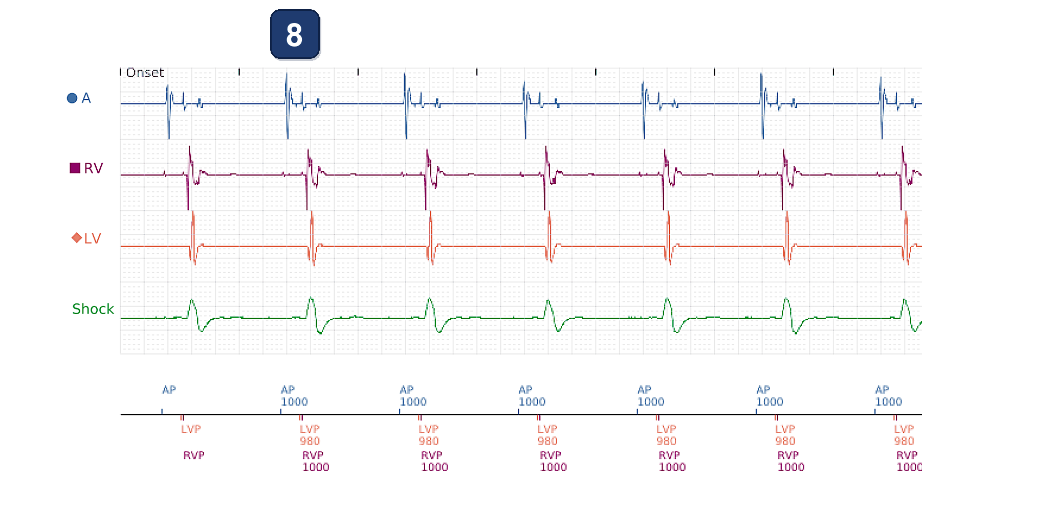 Électrogramme Boston Scientific CRT, segment 4/4 — Lire un rapport de suivi LATITUDE complet de CRT-D