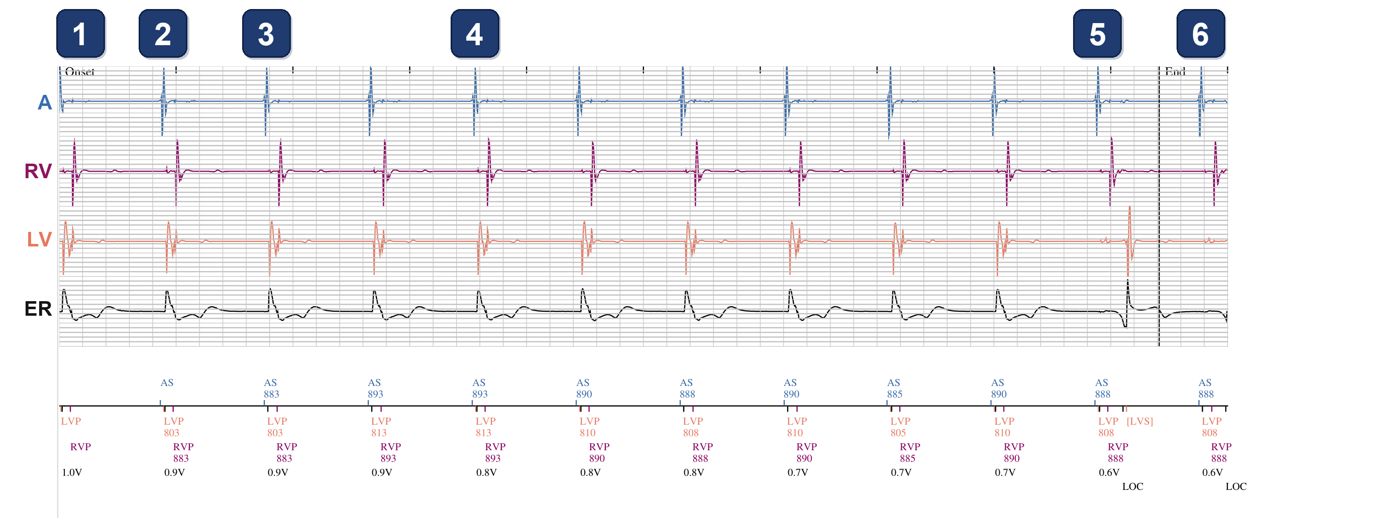 Électrogramme Boston Scientific CRT, segment 1/1 — Test de seuil VG automatique (PaceSafe) en ambulatoire