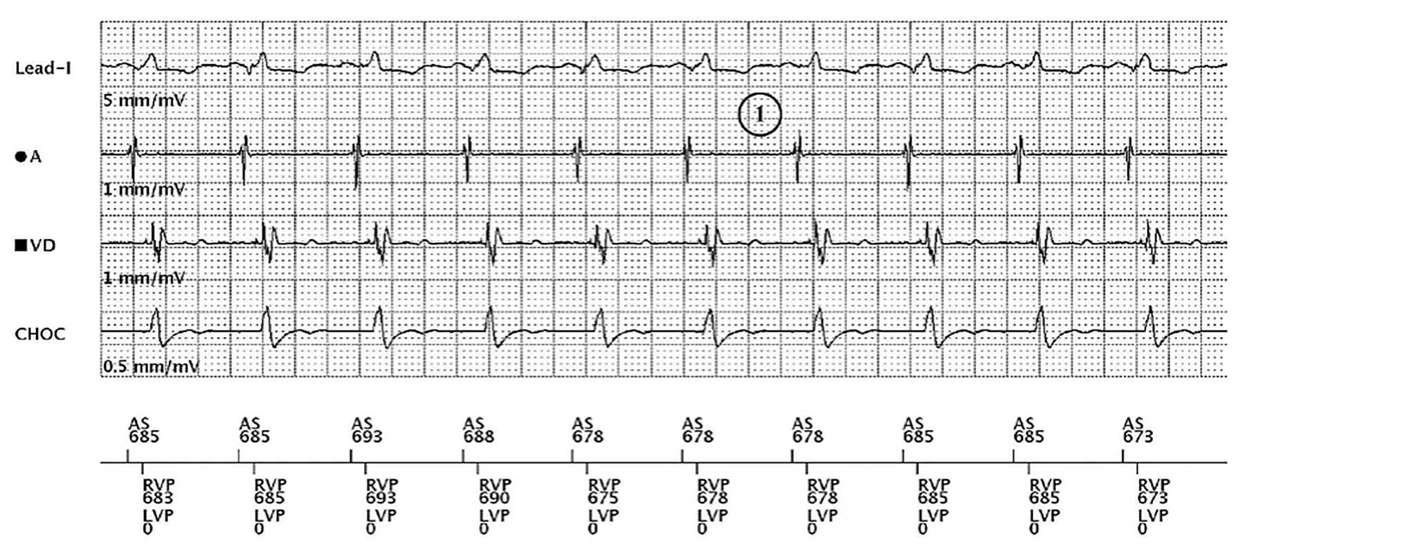 Électrogramme Boston Scientific CRT, segment 1/3 — Non-répondeur malgré 100 % de stimulation BiV