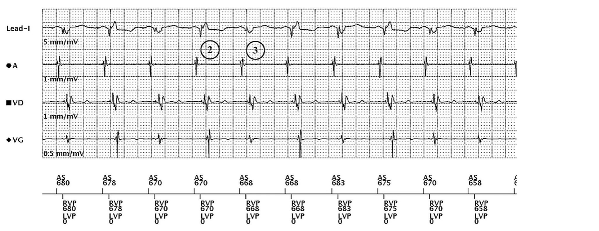 Électrogramme Boston Scientific CRT, segment 2/3 — Non-répondeur malgré 100 % de stimulation BiV