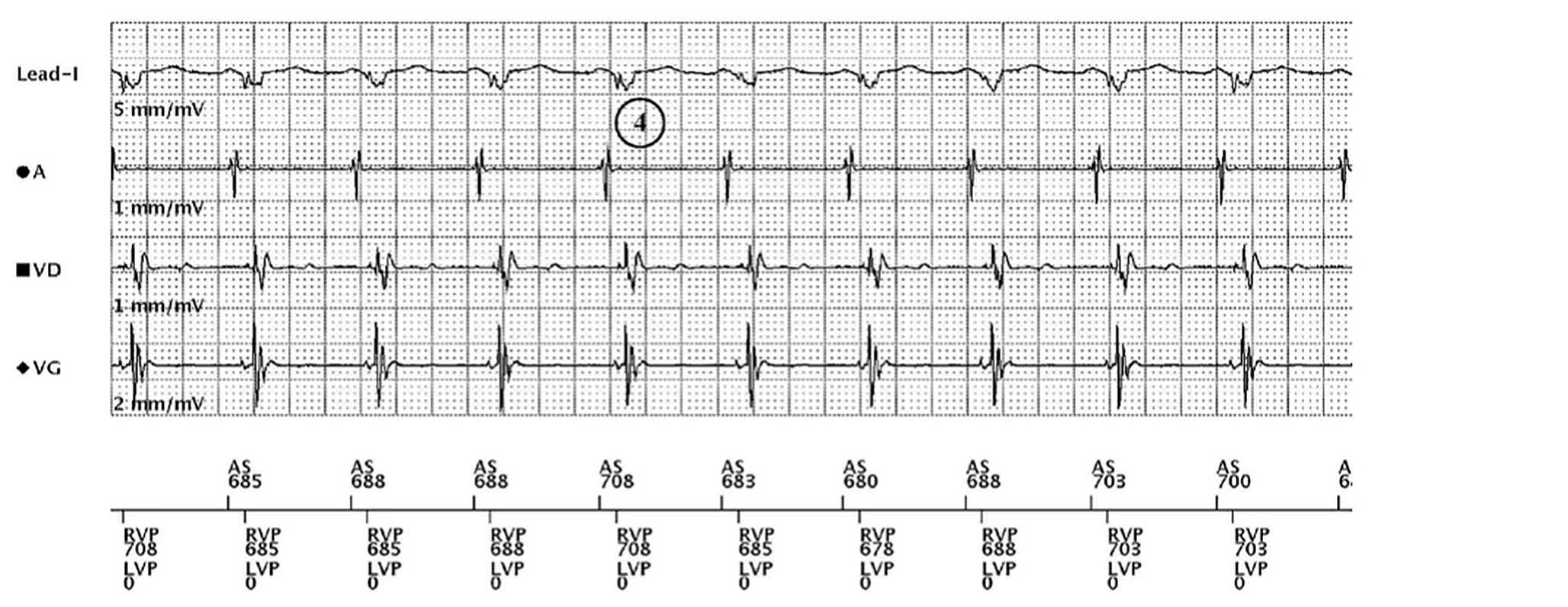 Électrogramme Boston Scientific CRT, segment 3/3 — Non-répondeur malgré 100 % de stimulation BiV