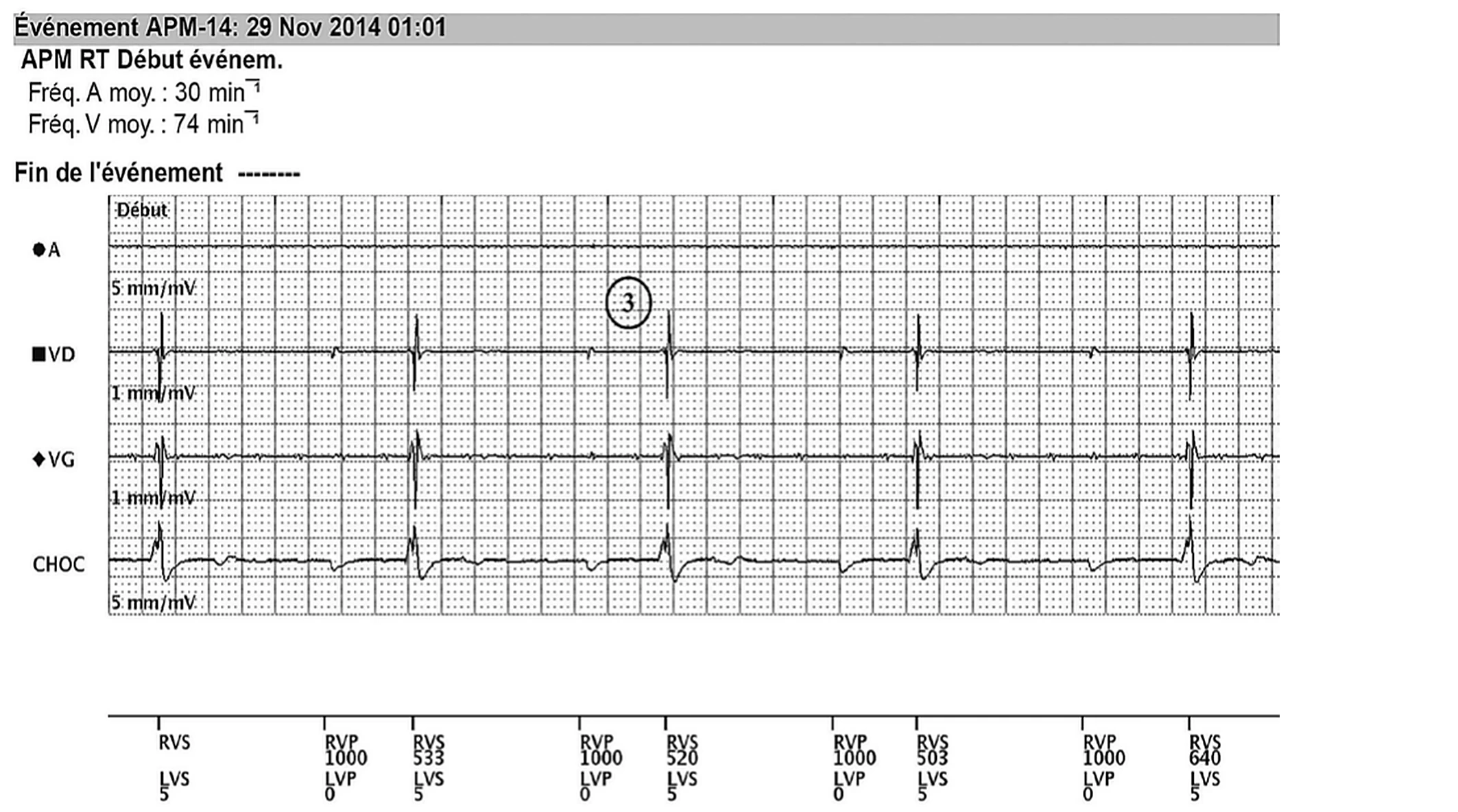 Électrogramme Boston Scientific CRT, segment 3/8 — EGM temps réel télétransmis chez un patient dialysé
