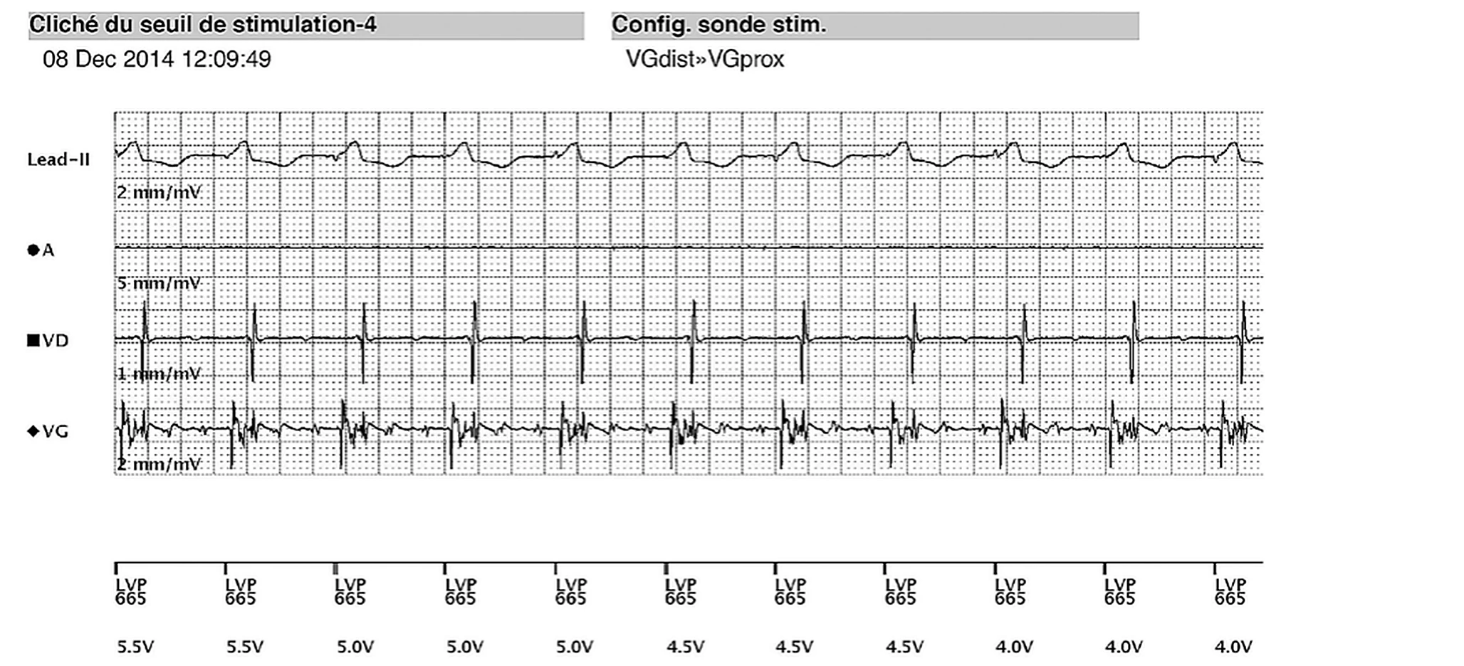 Électrogramme Boston Scientific CRT, segment 5/8 — EGM temps réel télétransmis chez un patient dialysé