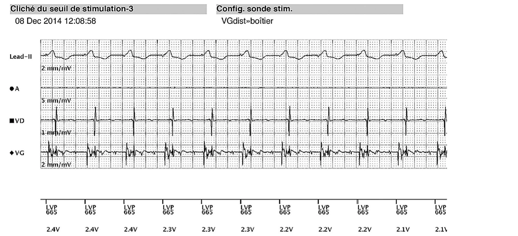 Électrogramme Boston Scientific CRT, segment 7/8 — EGM temps réel télétransmis chez un patient dialysé