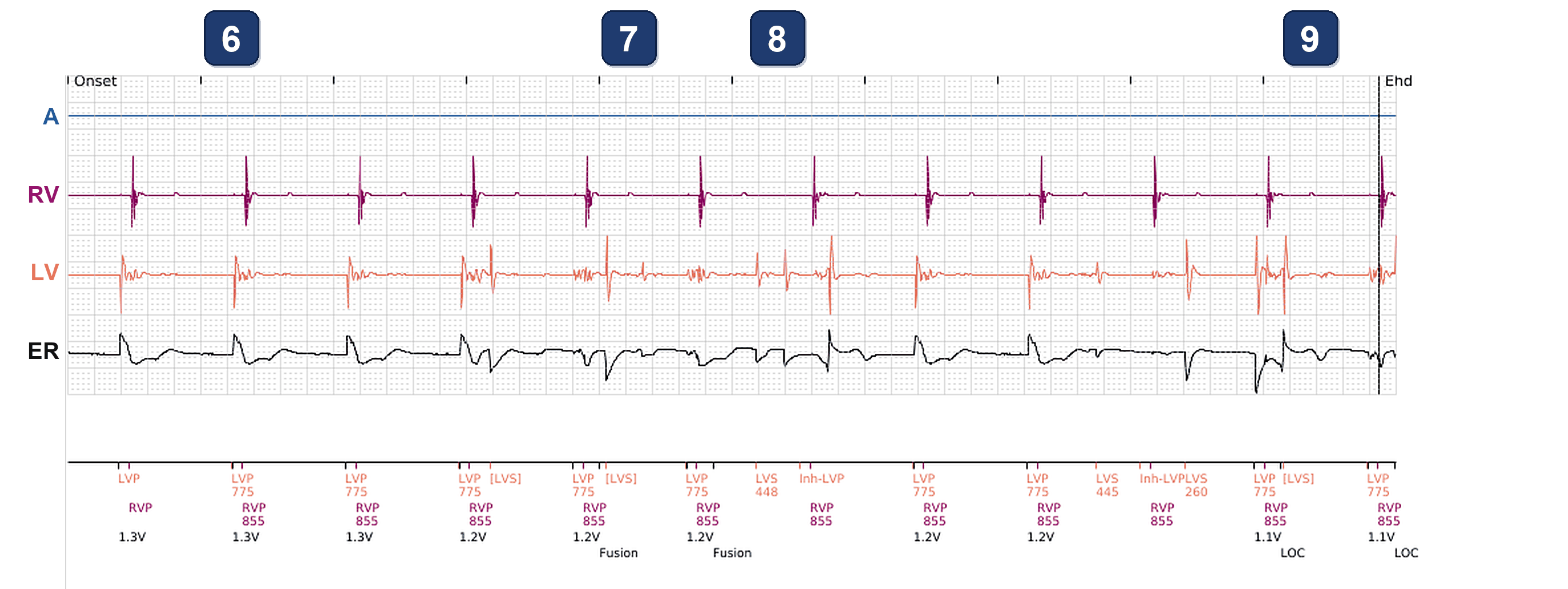 Électrogramme Boston Scientific CRT, segment 4/4 — Alerte d'impédance VG et test PaceSafe VG anormal