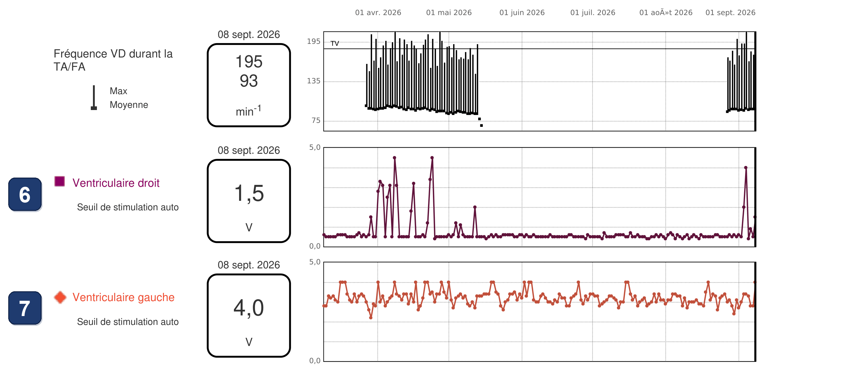 Électrogramme Boston Scientific CRT, segment 4/5 — BiV Trigger en FA, et le même patient 15 mois plus tard