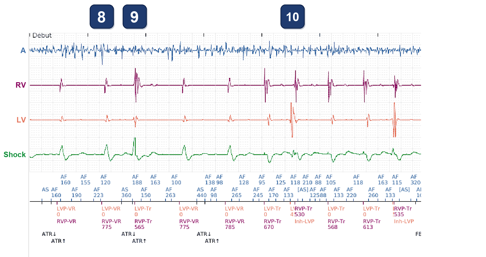 Électrogramme Boston Scientific CRT, segment 5/5 — BiV Trigger en FA, et le même patient 15 mois plus tard