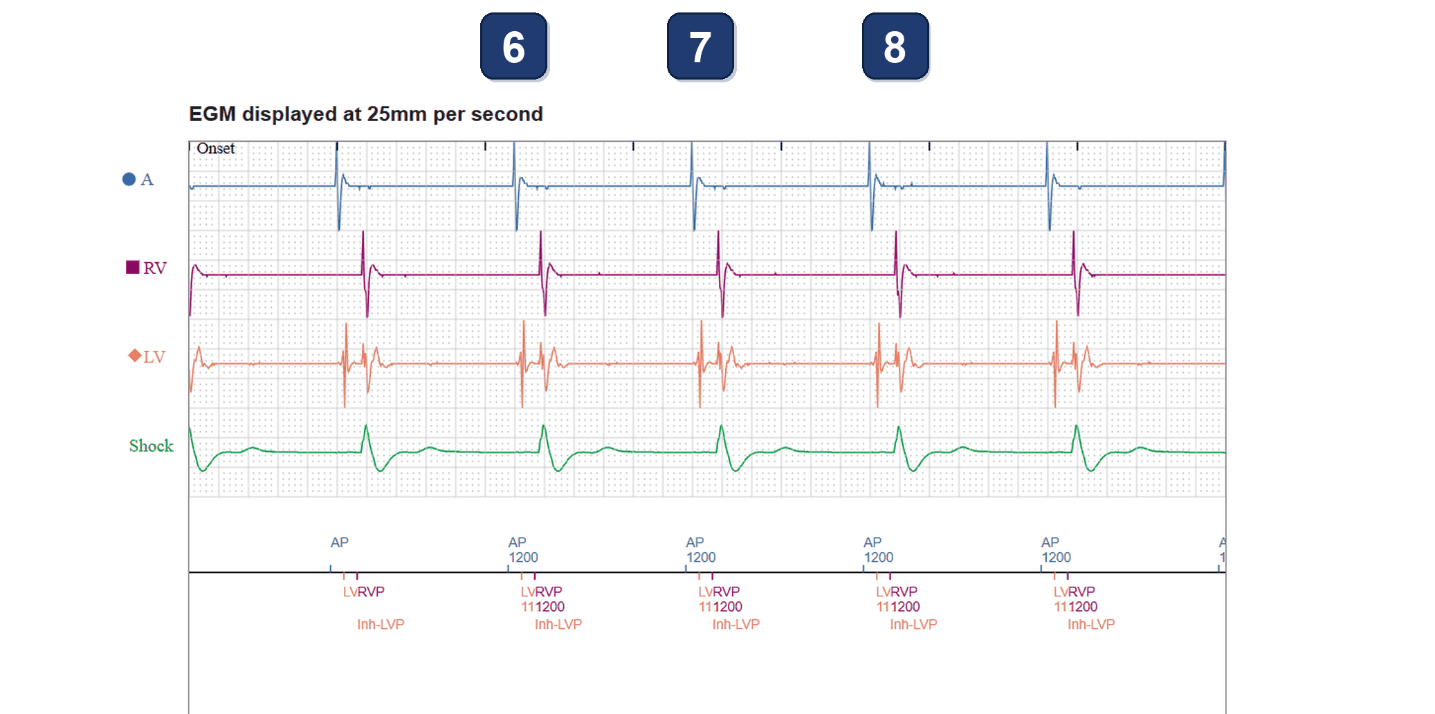 Électrogramme Boston Scientific CRT, segment 3/3 — CRT-D avec sonde de stimulation du système de conduction : saut des tendances VG