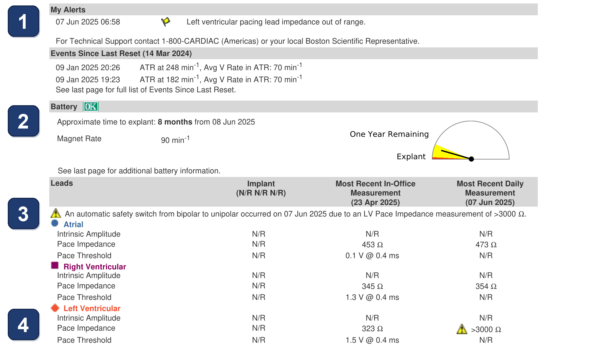 Électrogramme Boston Scientific CRT, segment 1/7 — Alerte d'impédance VG hors limites en fin de vie de pile